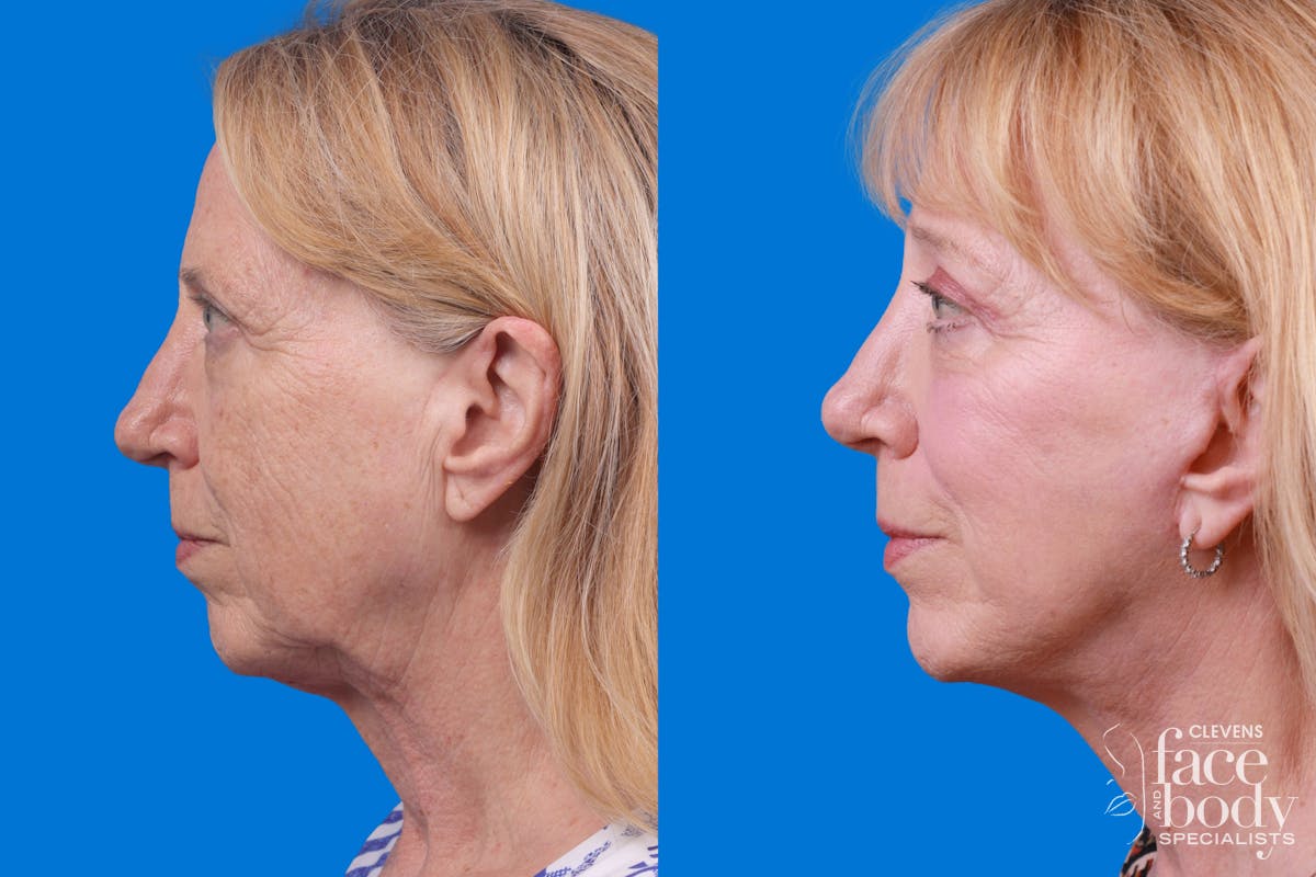 Facelift Before & After Gallery - Patient 122593604 - Image 5