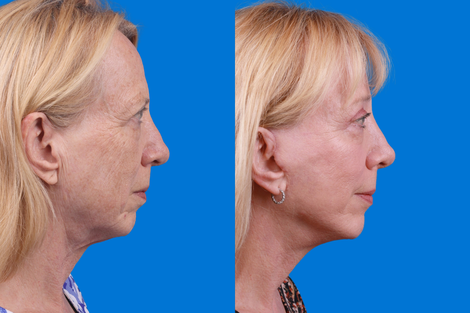 Eyelid Surgery Before & After Gallery - Patient 386386 - Image 3