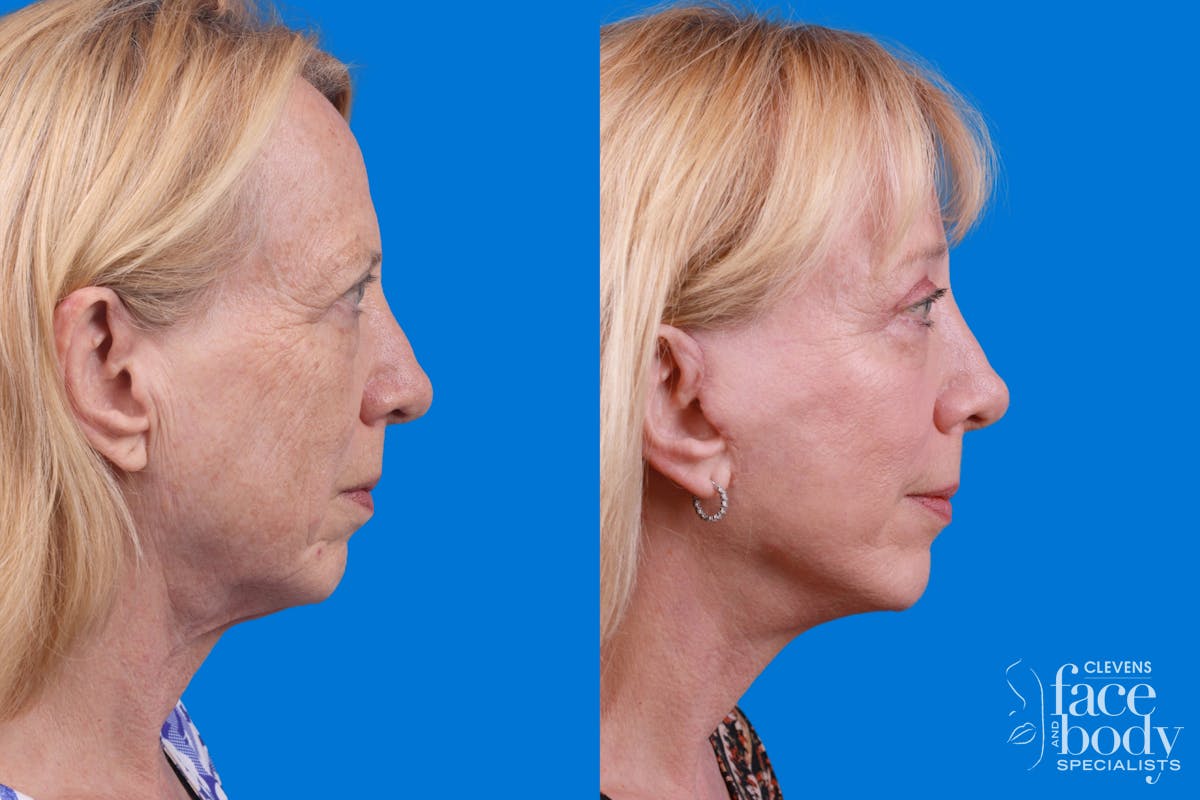 Facelift Before & After Gallery - Patient 122593604 - Image 1