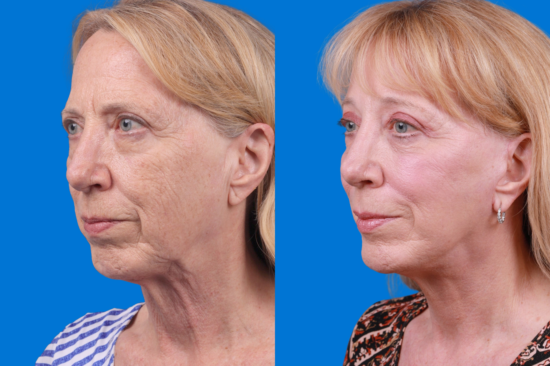 Eyelid Surgery Before & After Gallery - Patient 386386 - Image 4