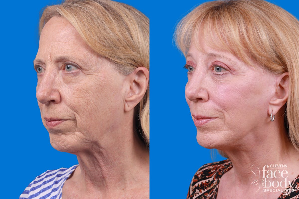 Facelift Before & After Gallery - Patient 122593604 - Image 4