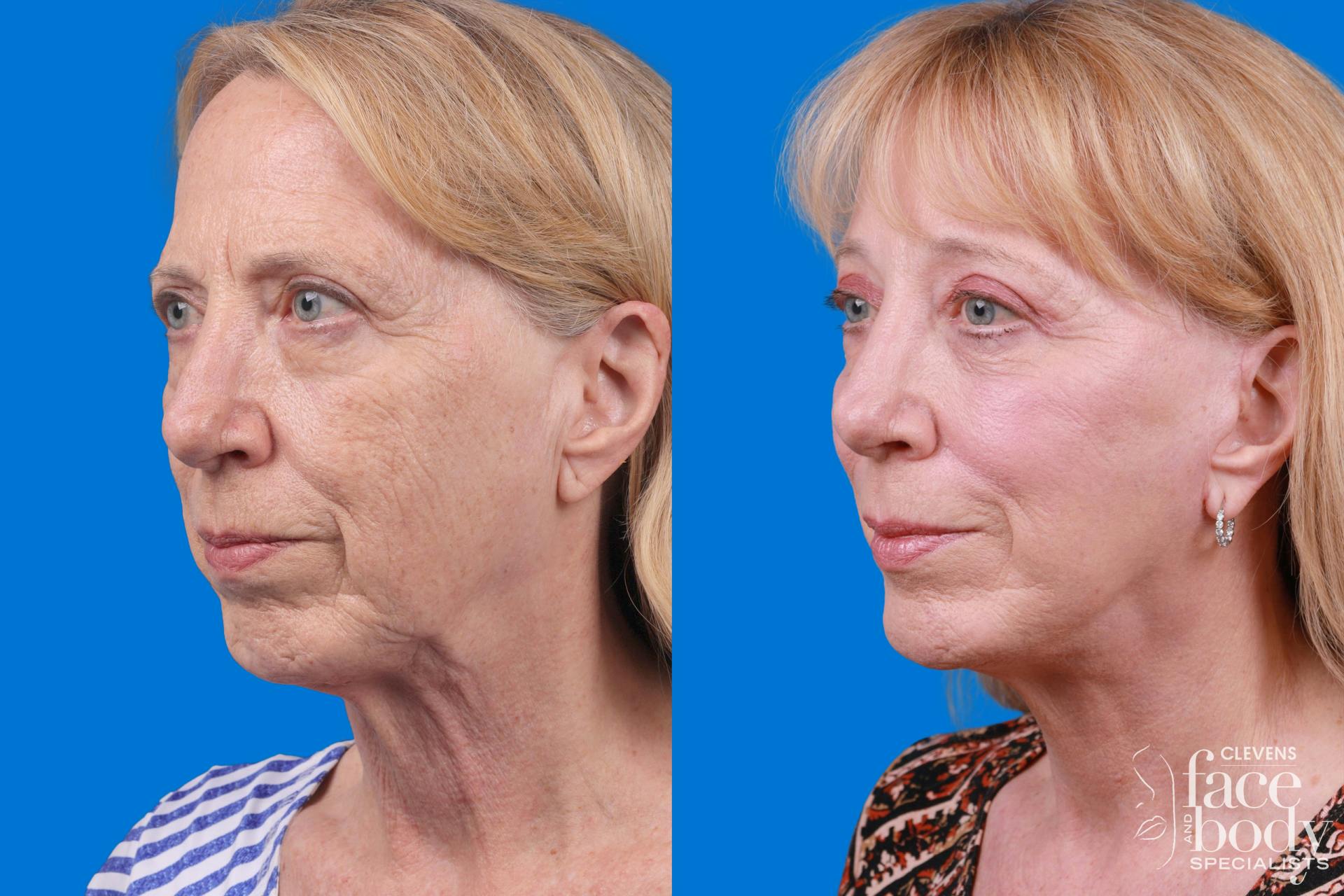 Facelift Before & After Gallery - Patient 122593604 - Image 4