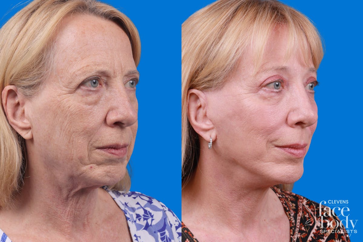 Facelift Before & After Gallery - Patient 122593604 - Image 2