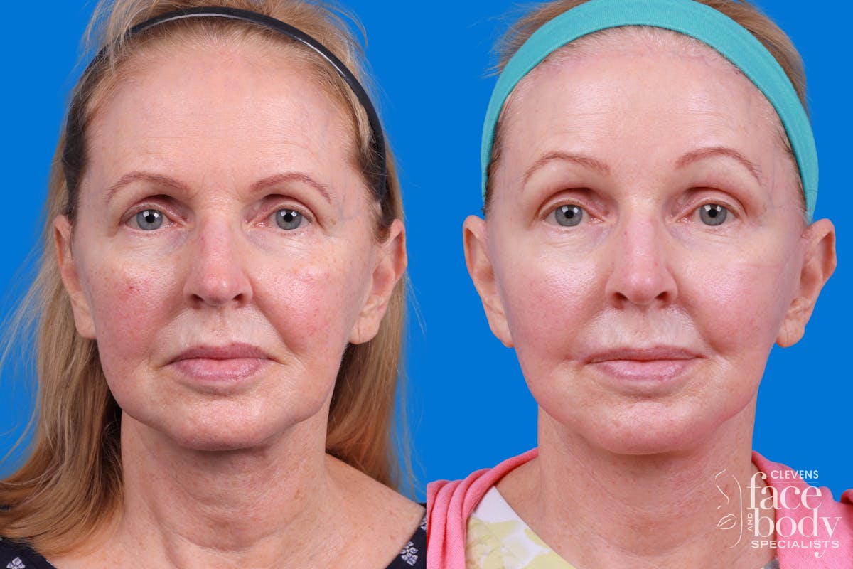 Facelift Before & After Gallery - Patient 400449 - Image 3