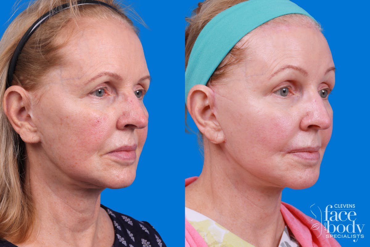 Facelift Before & After Gallery - Patient 400449 - Image 2