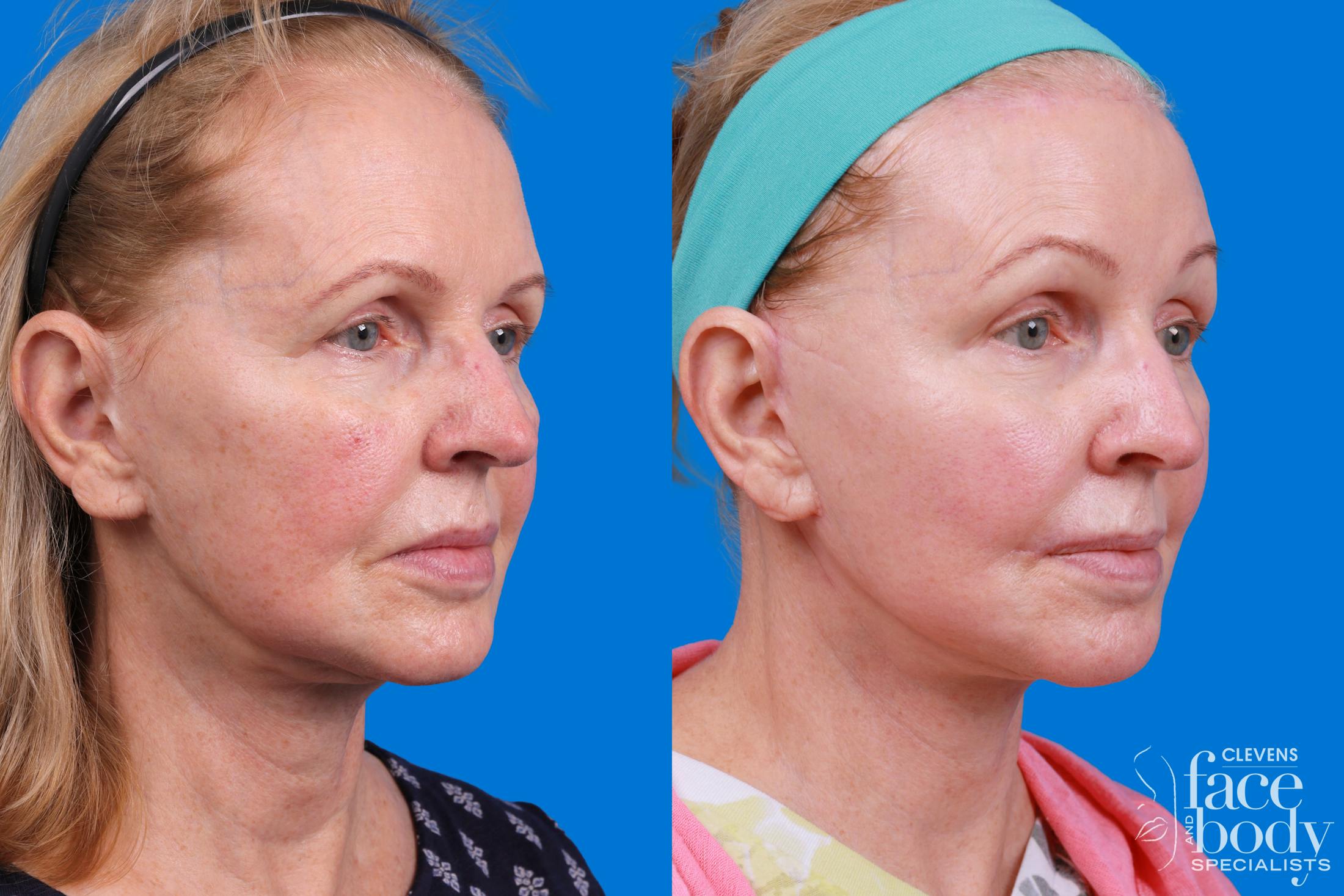 Facelift Before & After Gallery - Patient 400449 - Image 2
