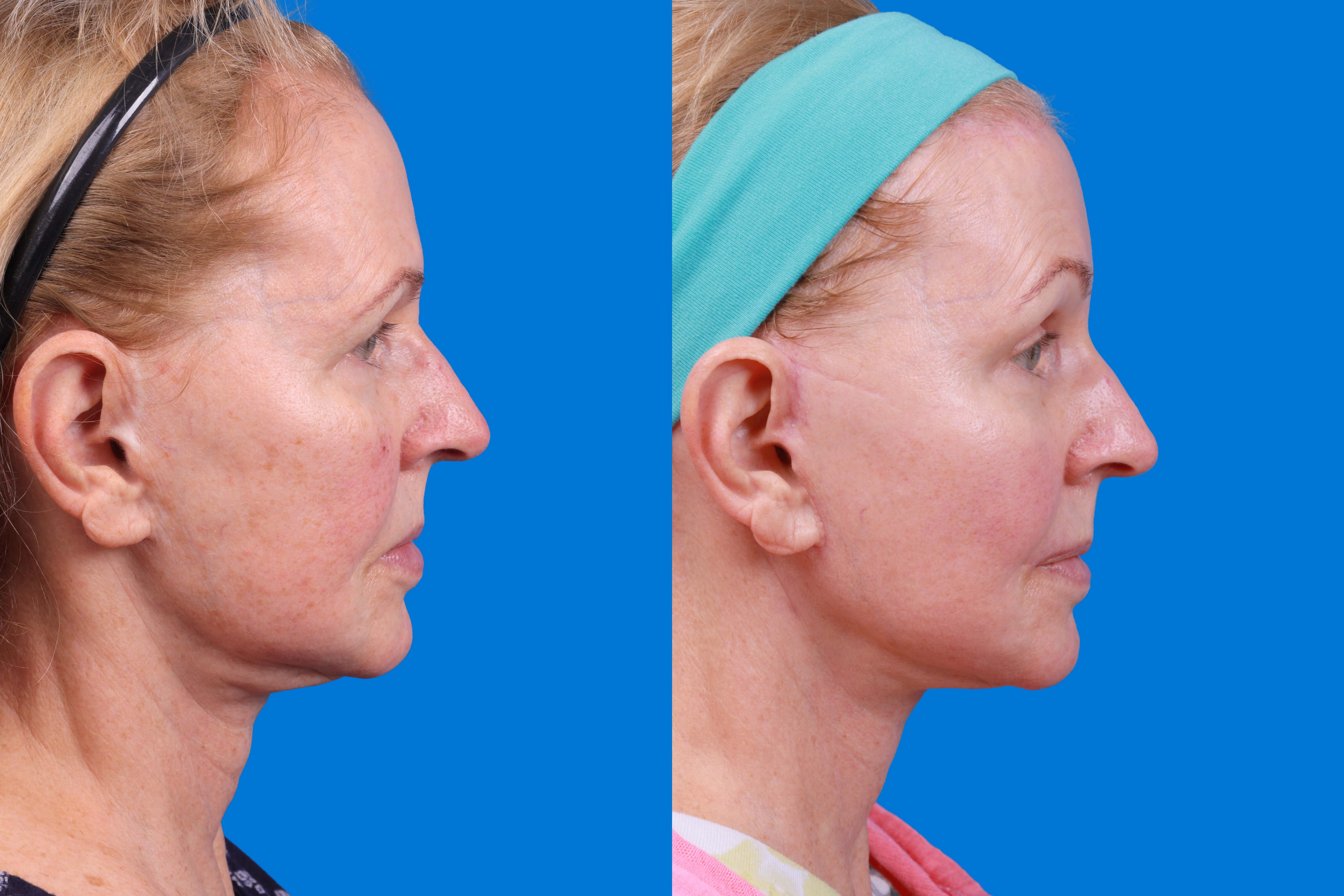 Facelift Before & After Gallery - Patient 231582 - Image 1