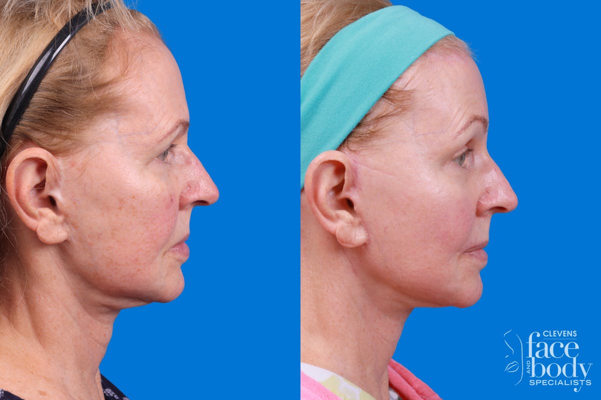 Facelift Before & After Gallery - Patient 400449 - Image 1