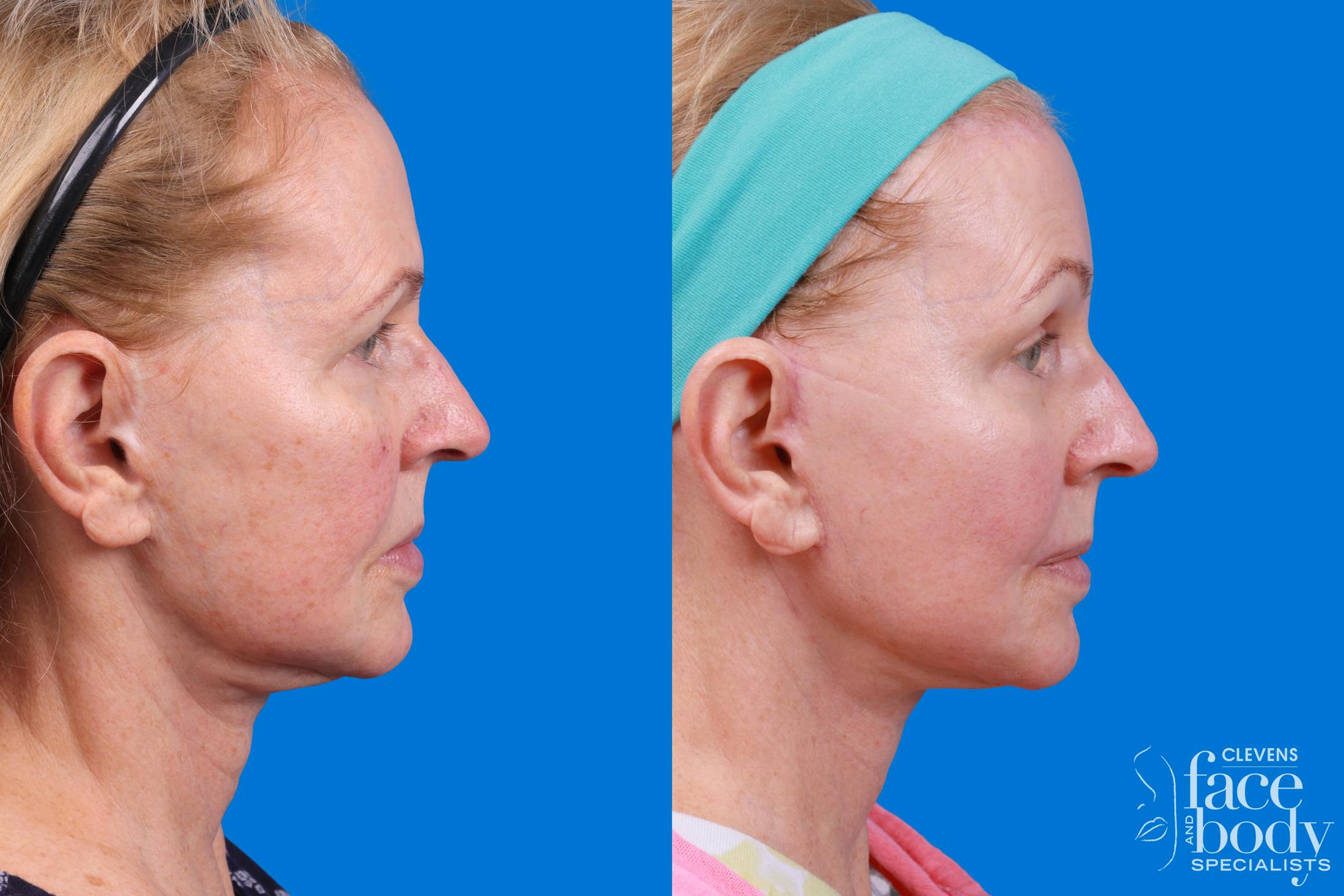 Facelift Before & After Gallery - Patient 400449 - Image 1