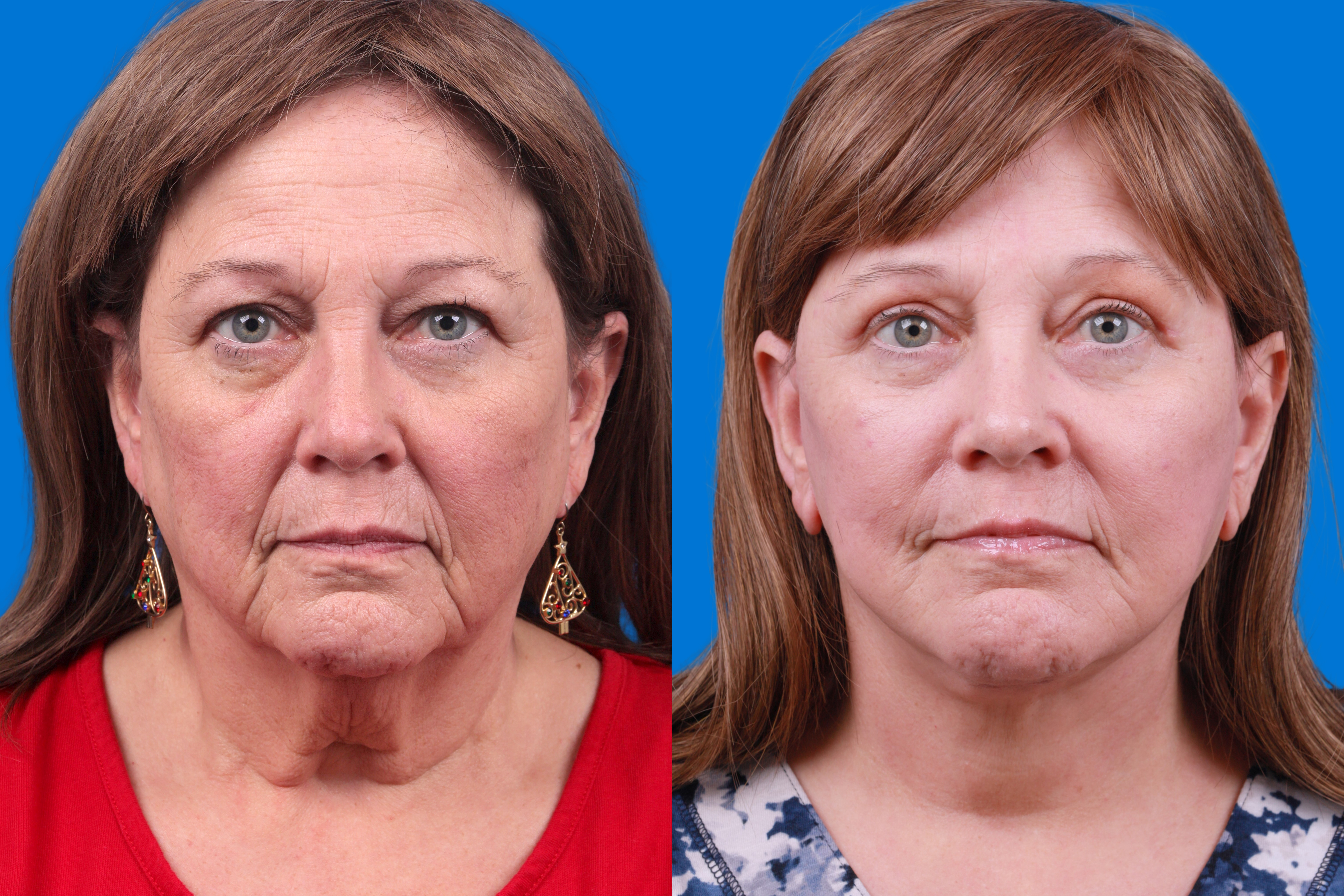 Facelift Before & After Gallery - Patient 122593605 - Image 3