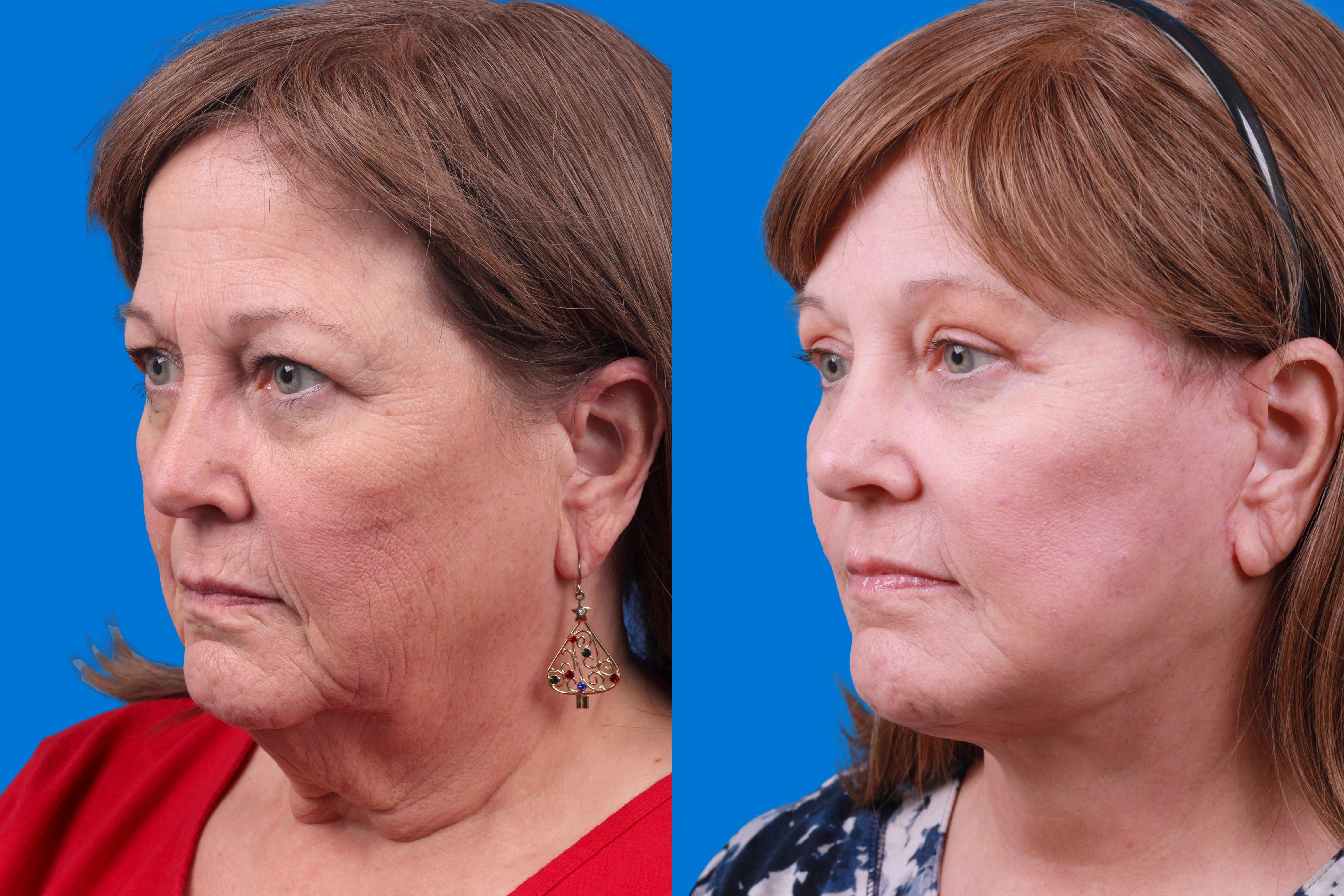 Facelift Before & After Gallery - Patient 122593605 - Image 4