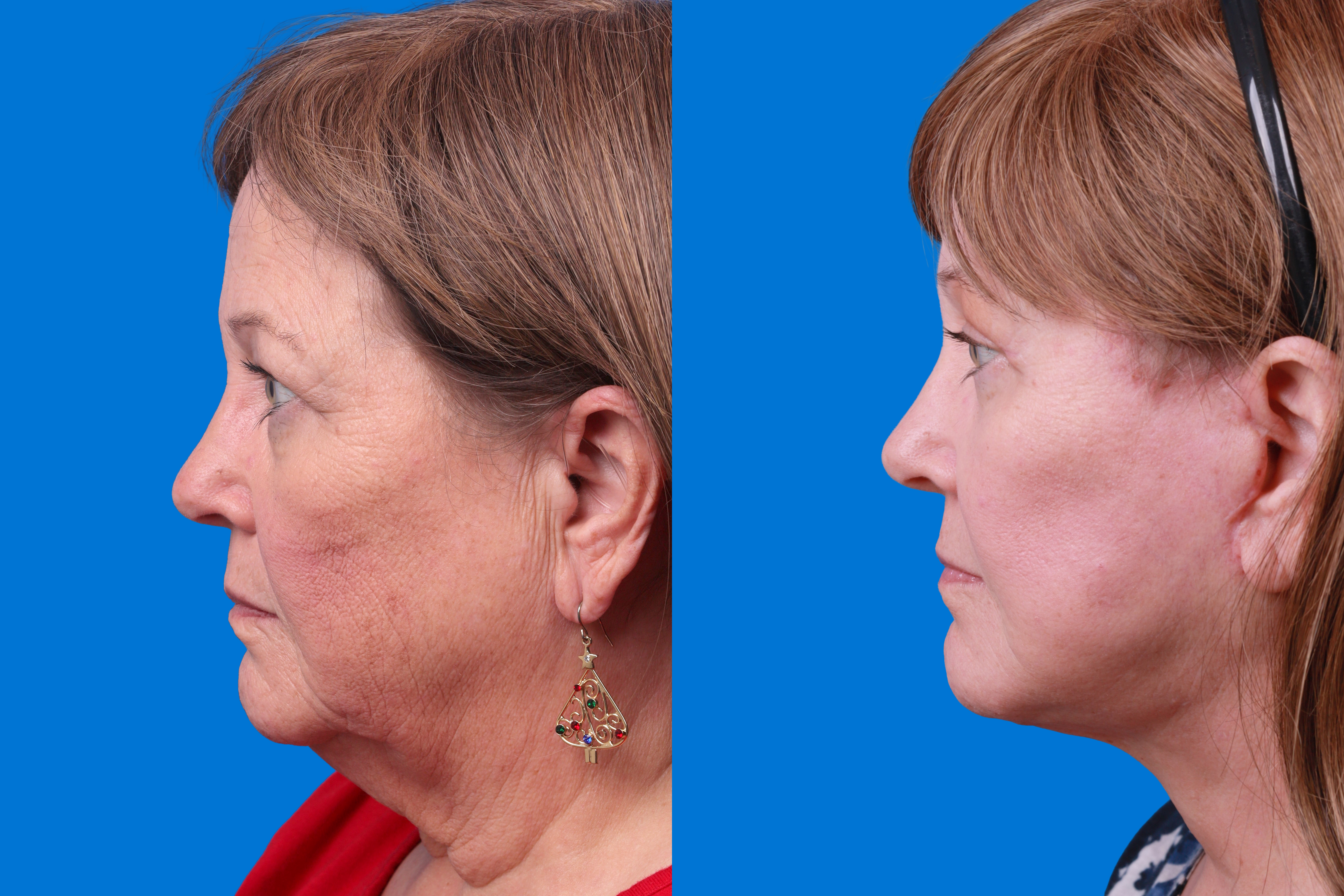 Facelift Before & After Gallery - Patient 122593605 - Image 5