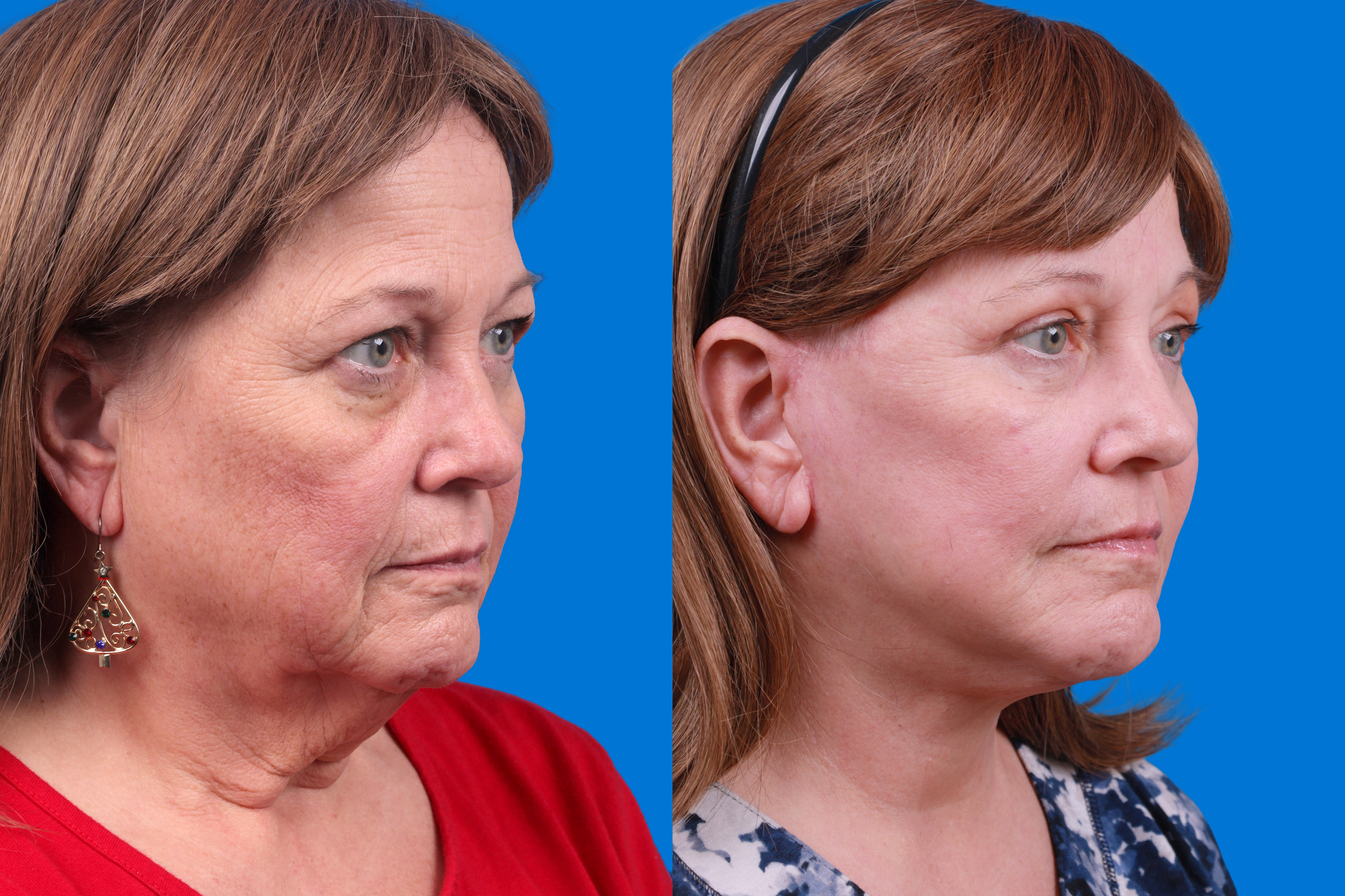 Facelift Before & After Gallery - Patient 122593605 - Image 2