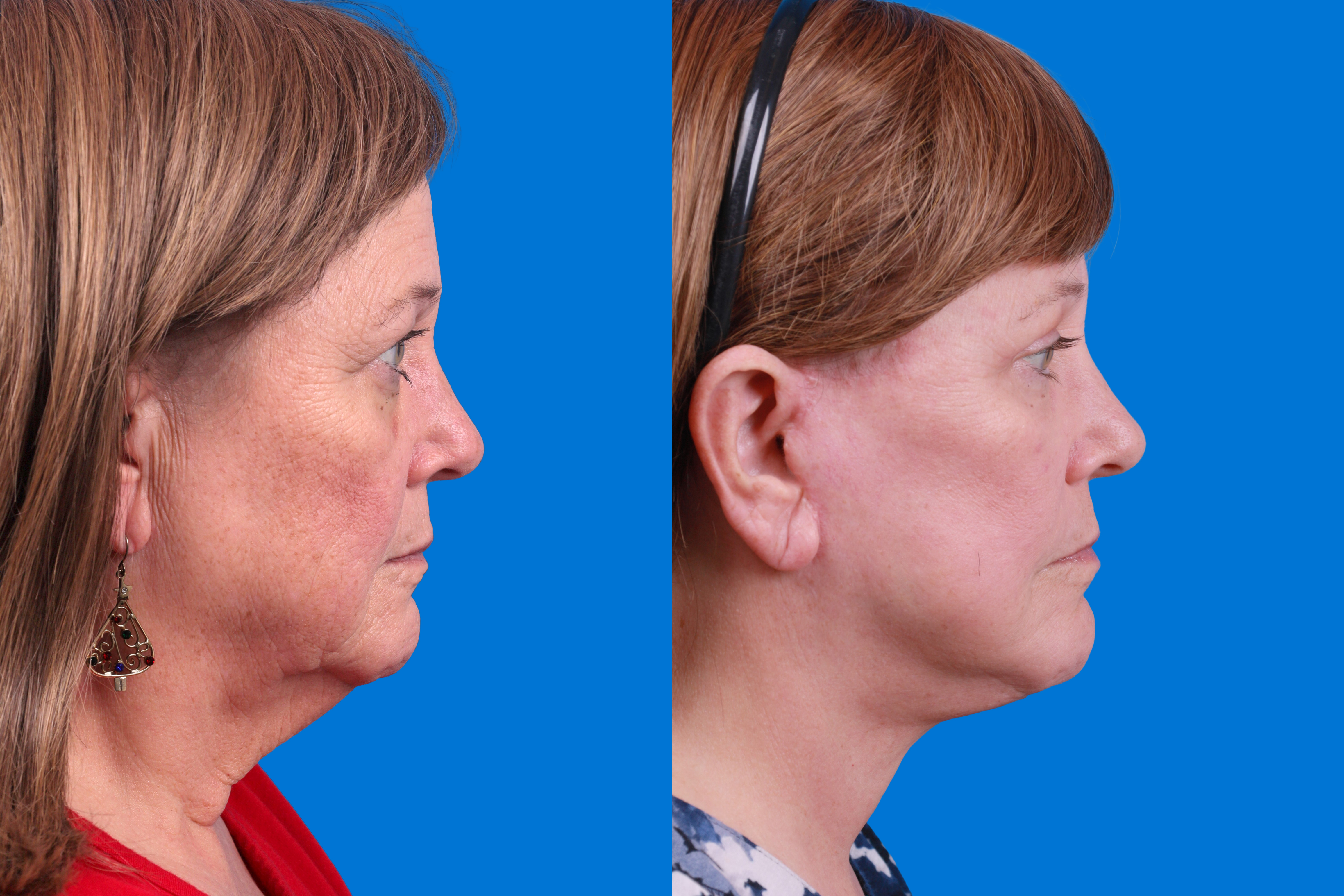 Facelift Before & After Gallery - Patient 122593605 - Image 1