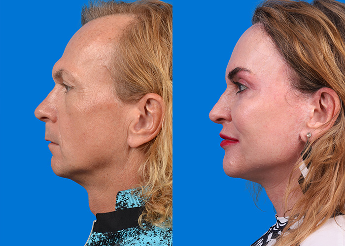 Facial Feminization Before & After Gallery - Patient 274243 - Image 1