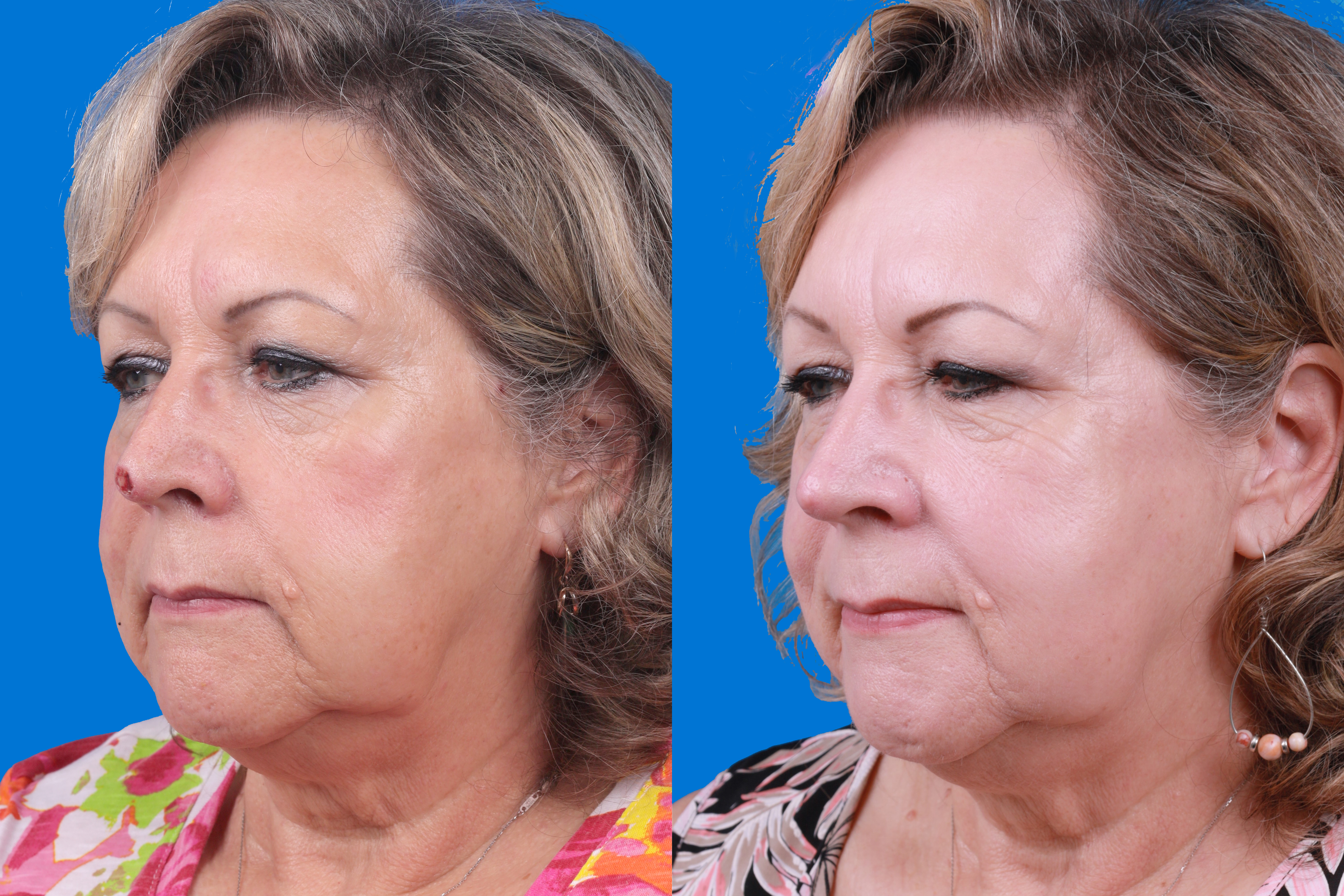 Mohs Surgery and Skin Cancer Before & After Gallery - Patient 122593786 - Image 1