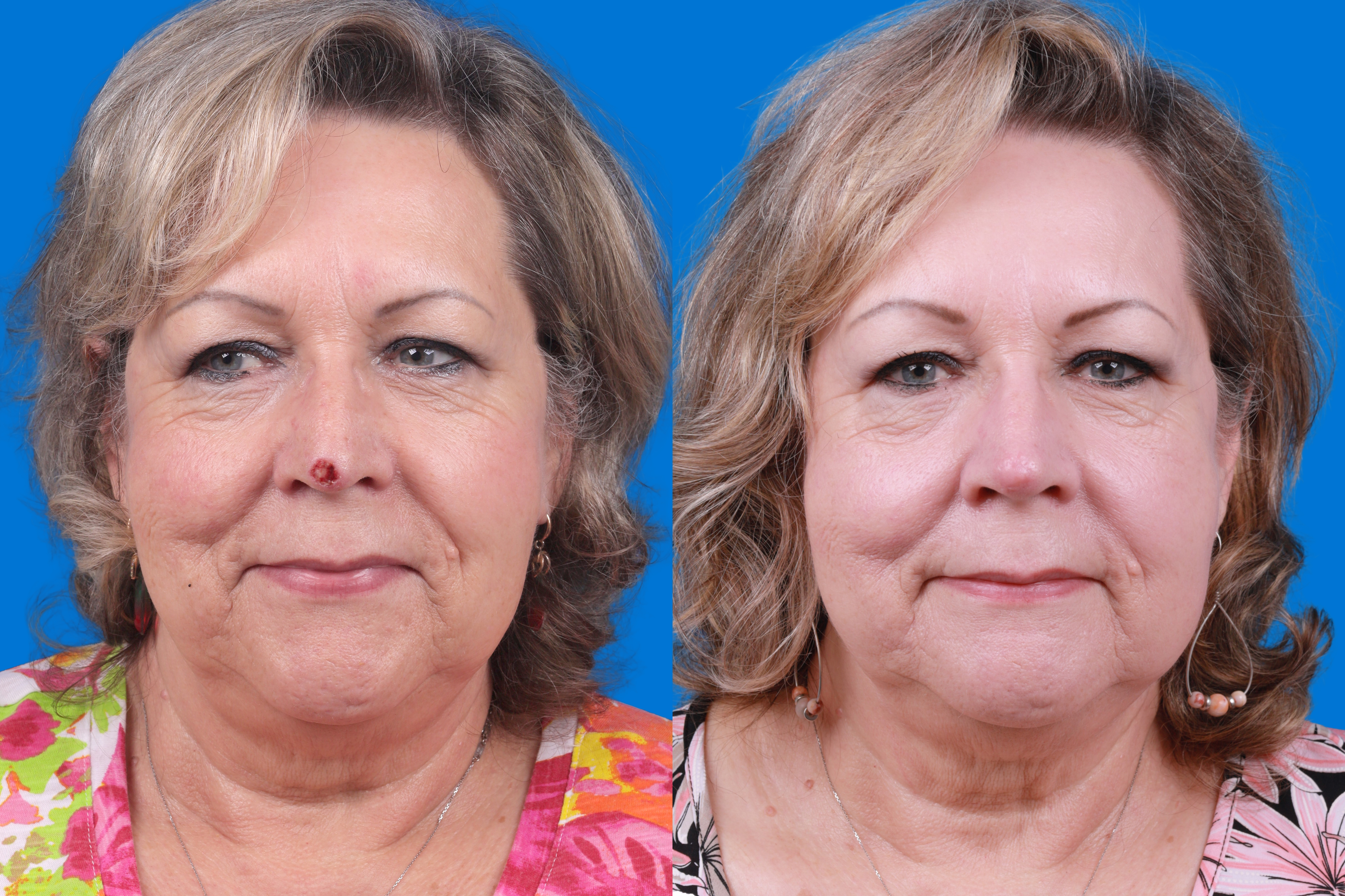 Mohs Surgery and Skin Cancer Before & After Gallery - Patient 122593786 - Image 2