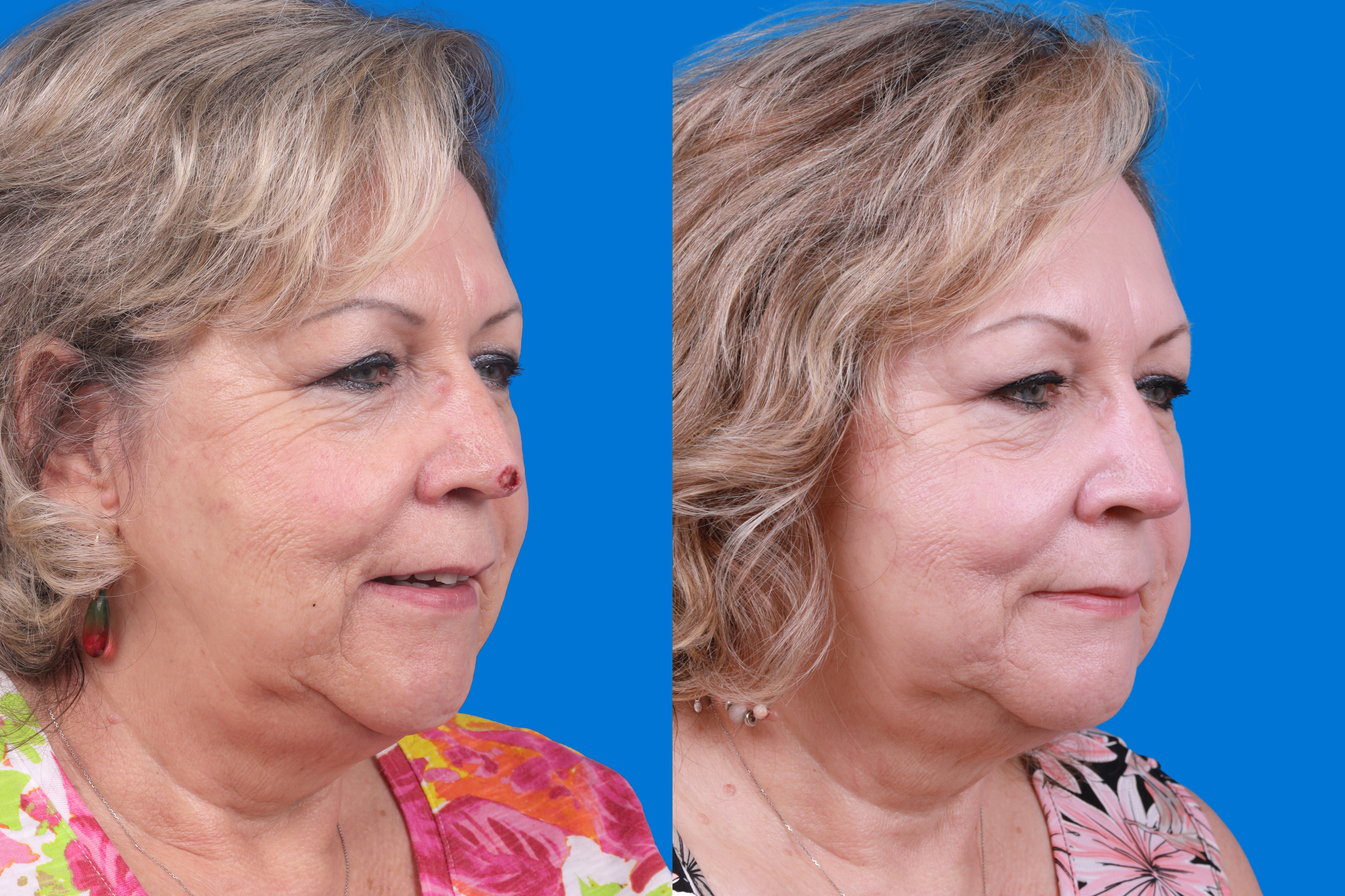 Mohs Surgery and Skin Cancer Before & After Gallery - Patient 122593786 - Image 3