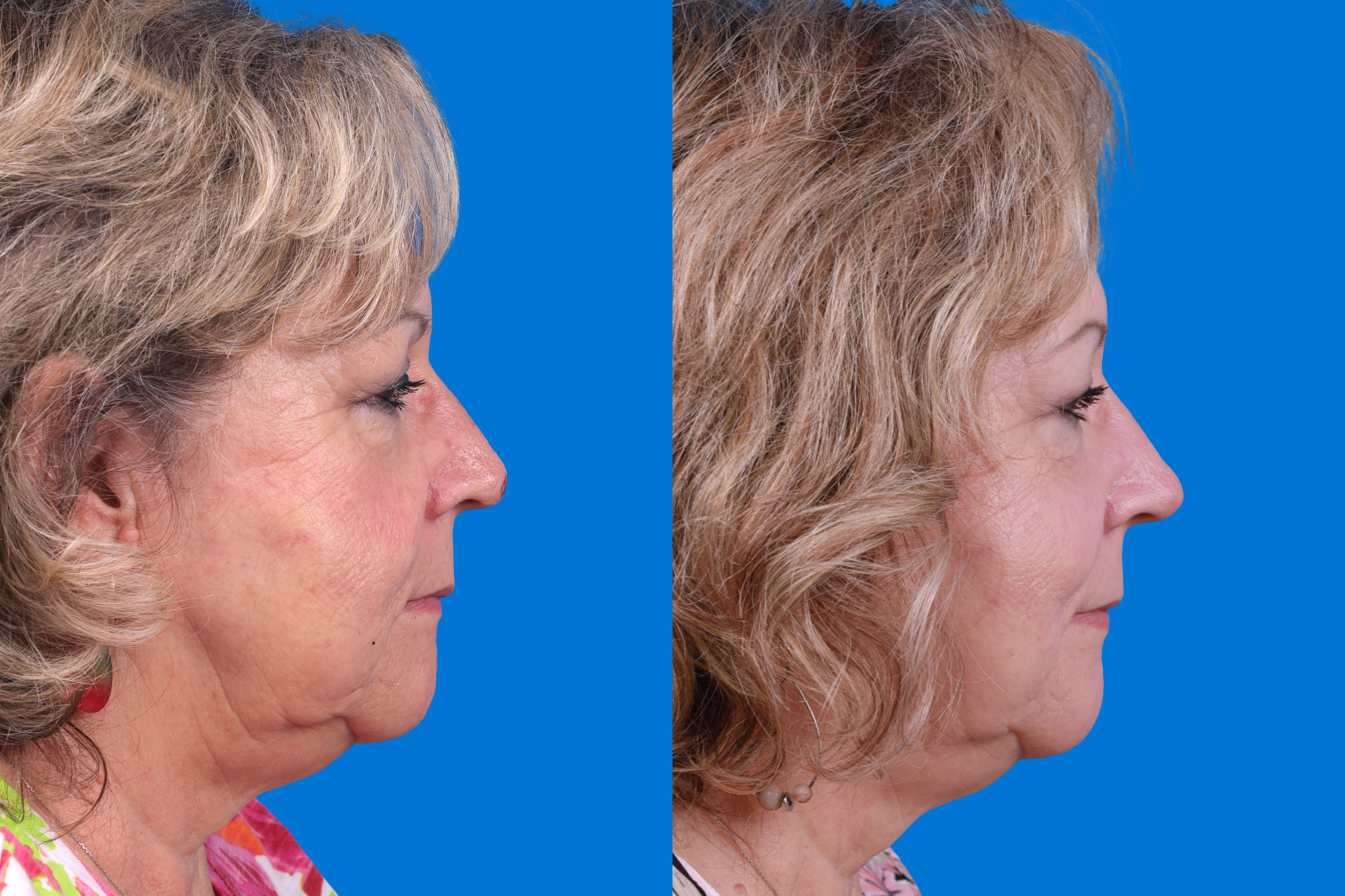 Mohs Surgery and Skin Cancer Before & After Gallery - Patient 122593786 - Image 4