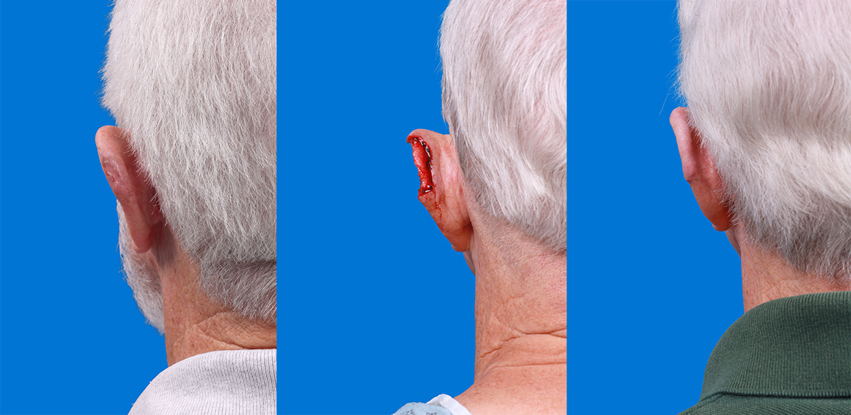 Mohs Surgery and Skin Cancer Before & After Gallery - Patient 159932 - Image 2