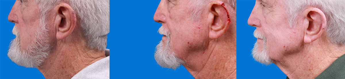 Mohs Surgery and Skin Cancer Before & After Gallery - Patient 159932 - Image 1