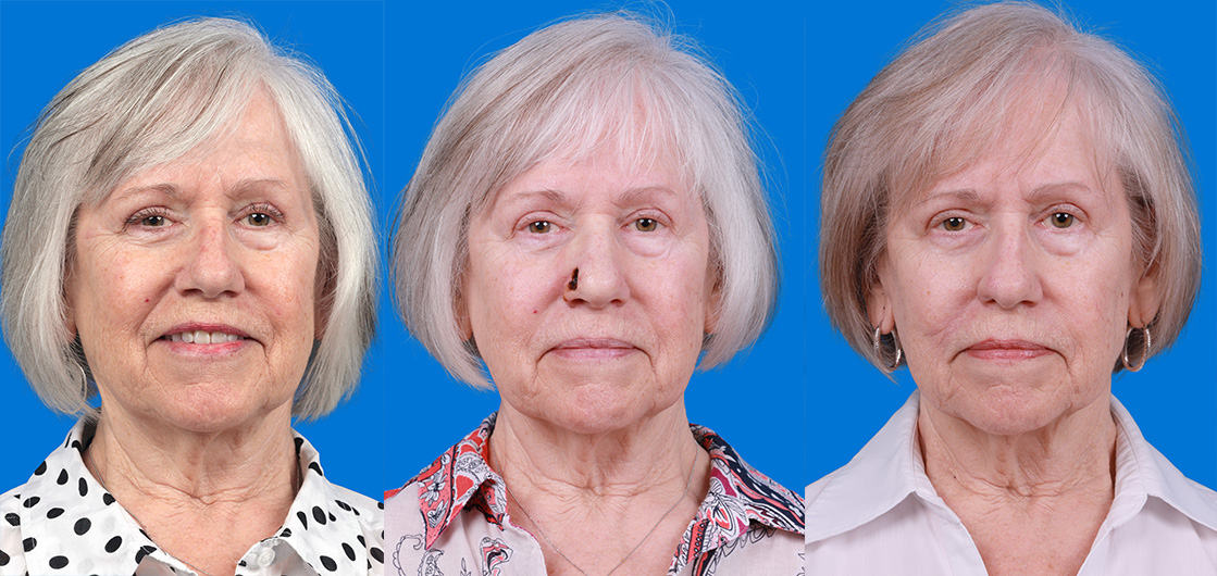 Mohs Surgery and Skin Cancer Before & After Gallery - Patient 346203 - Image 1