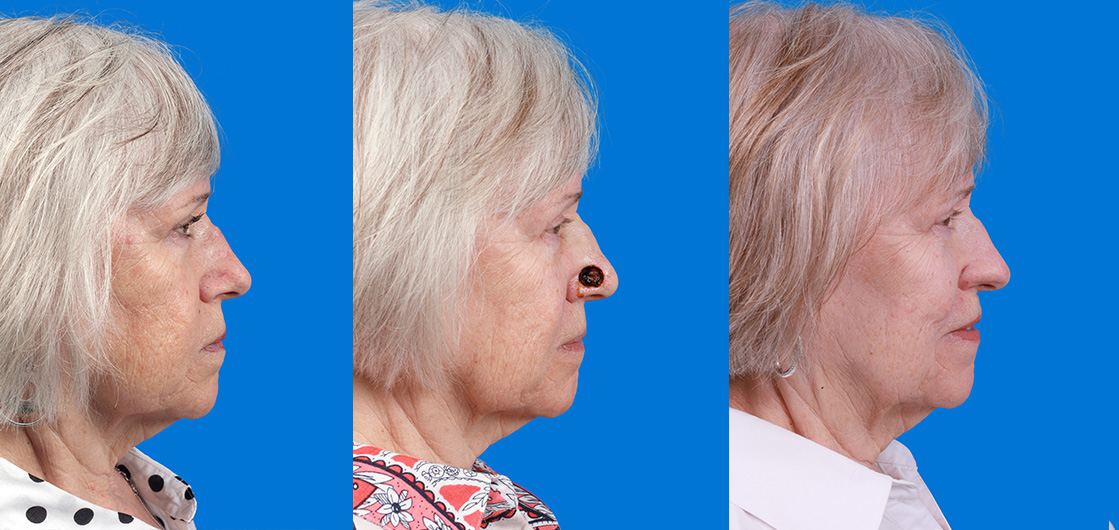 Mohs Surgery and Skin Cancer Before & After Gallery - Patient 346203 - Image 3