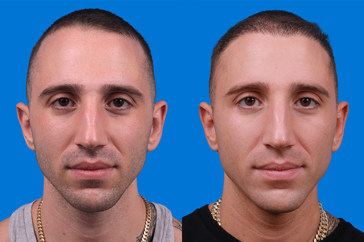 Hair Restoration Before & After Gallery - Patient 104786 - Image 1