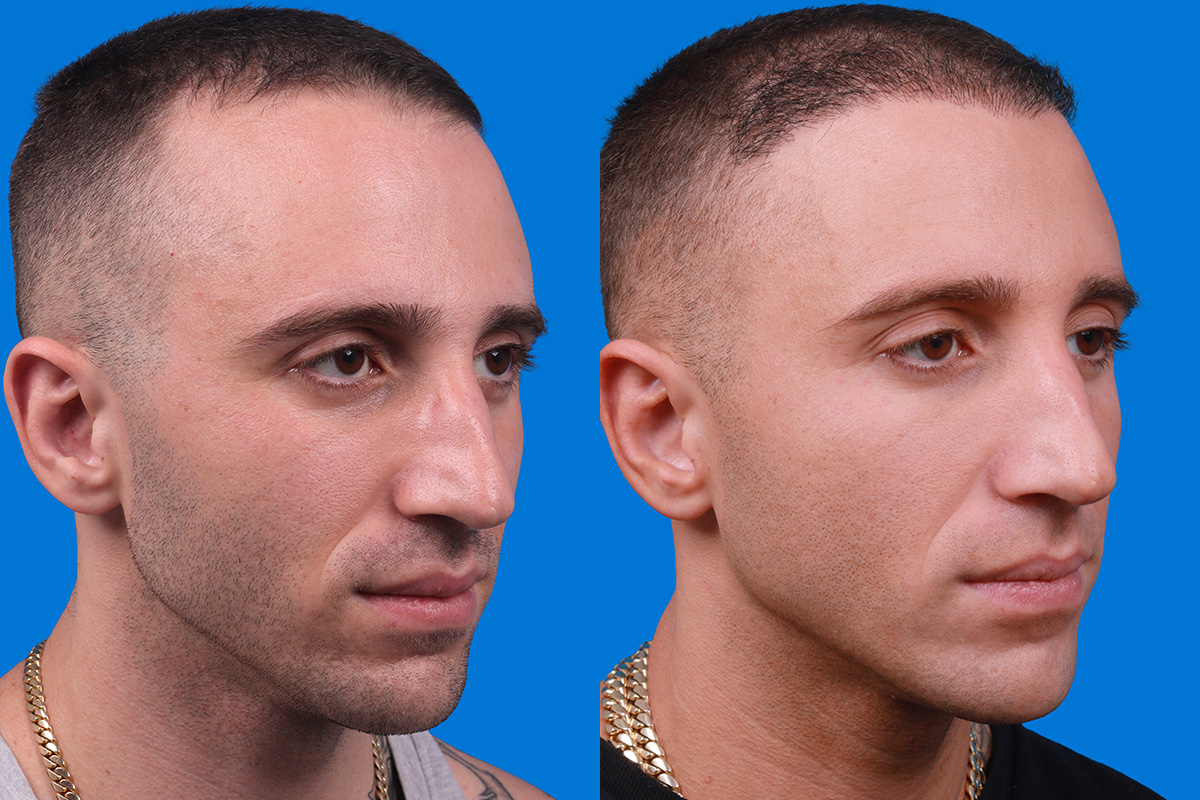Hair Restoration Before & After Gallery - Patient 104786 - Image 2