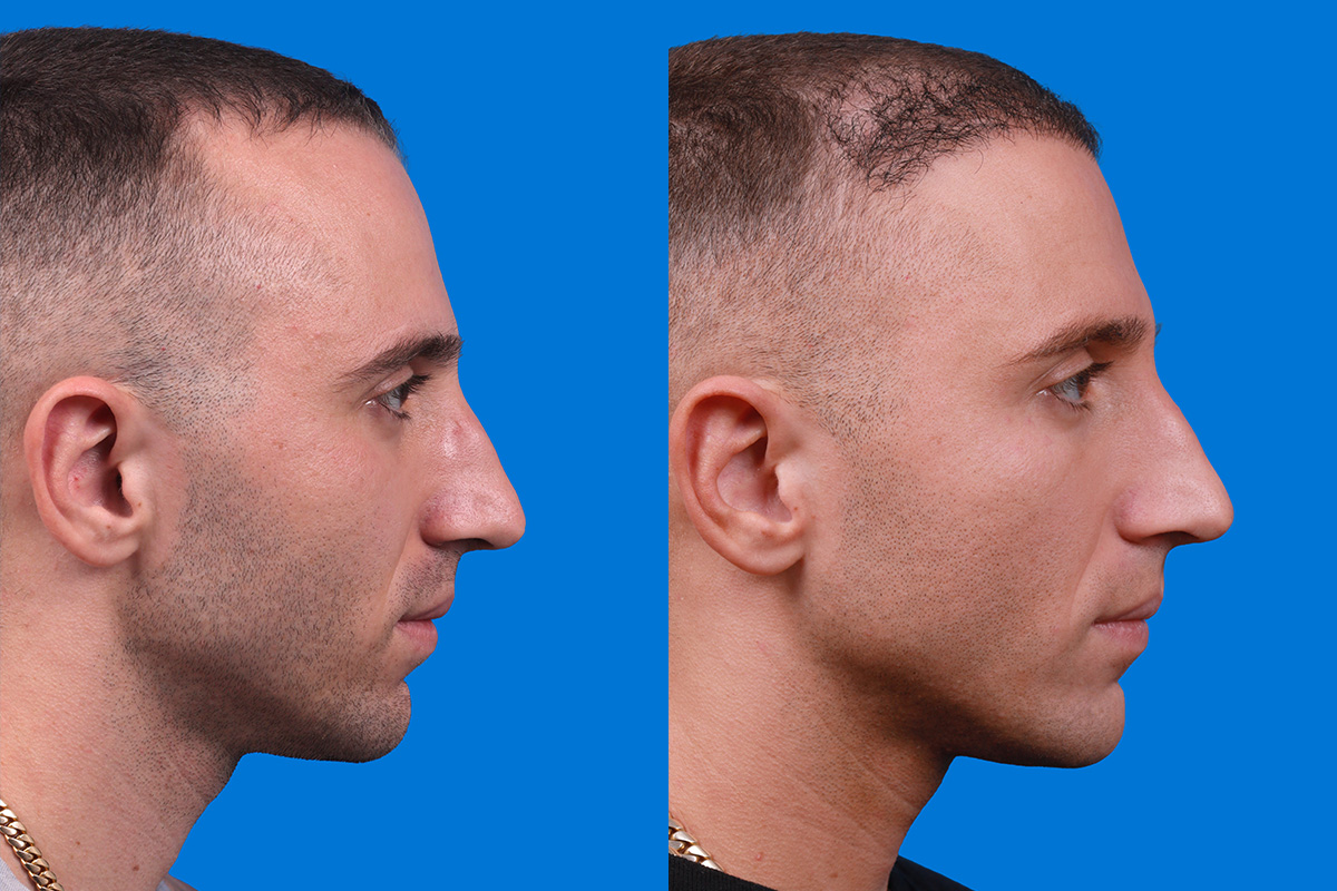 Hair Restoration Before & After Gallery - Patient 104786 - Image 3