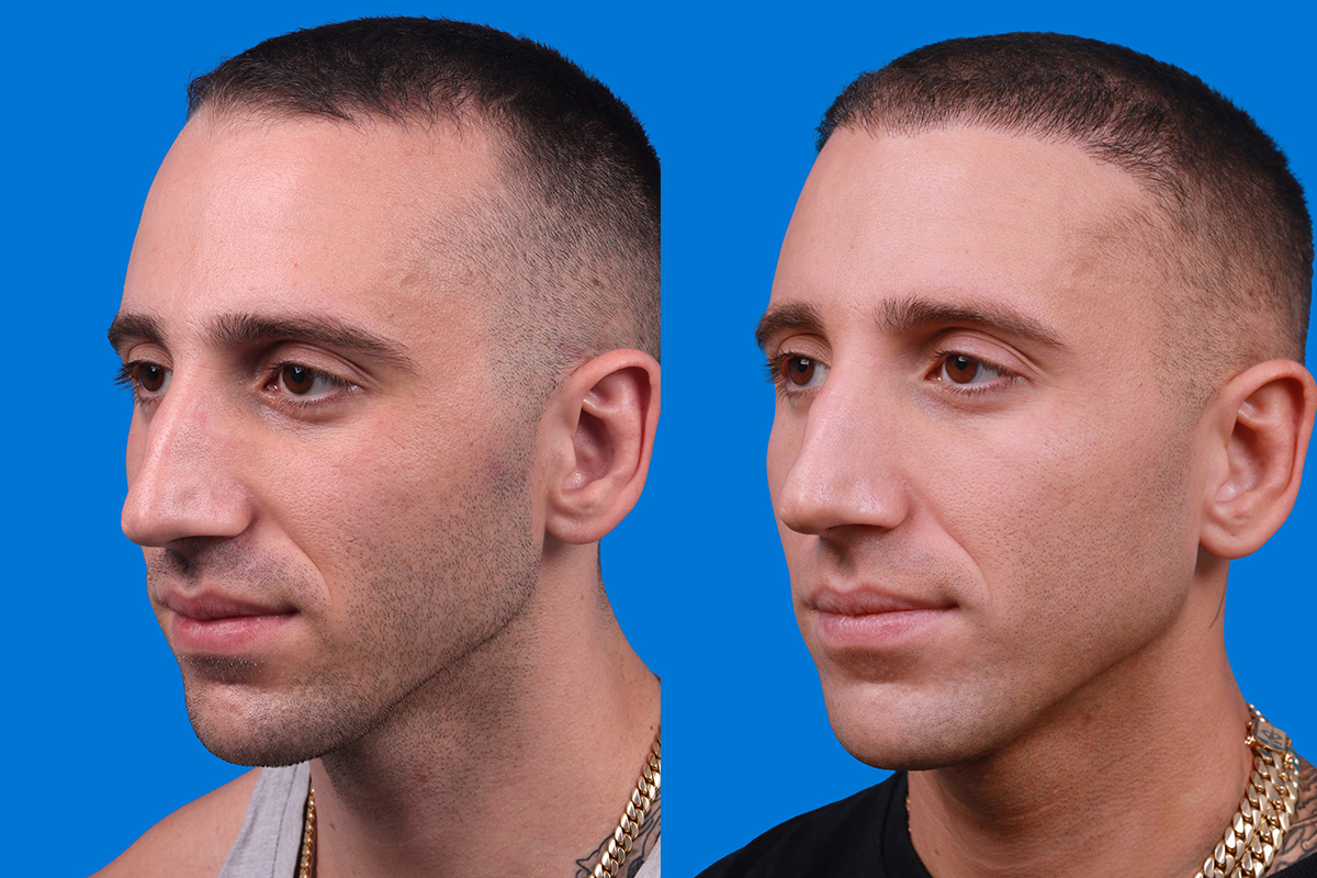 Hair Restoration Before & After Gallery - Patient 104786 - Image 4