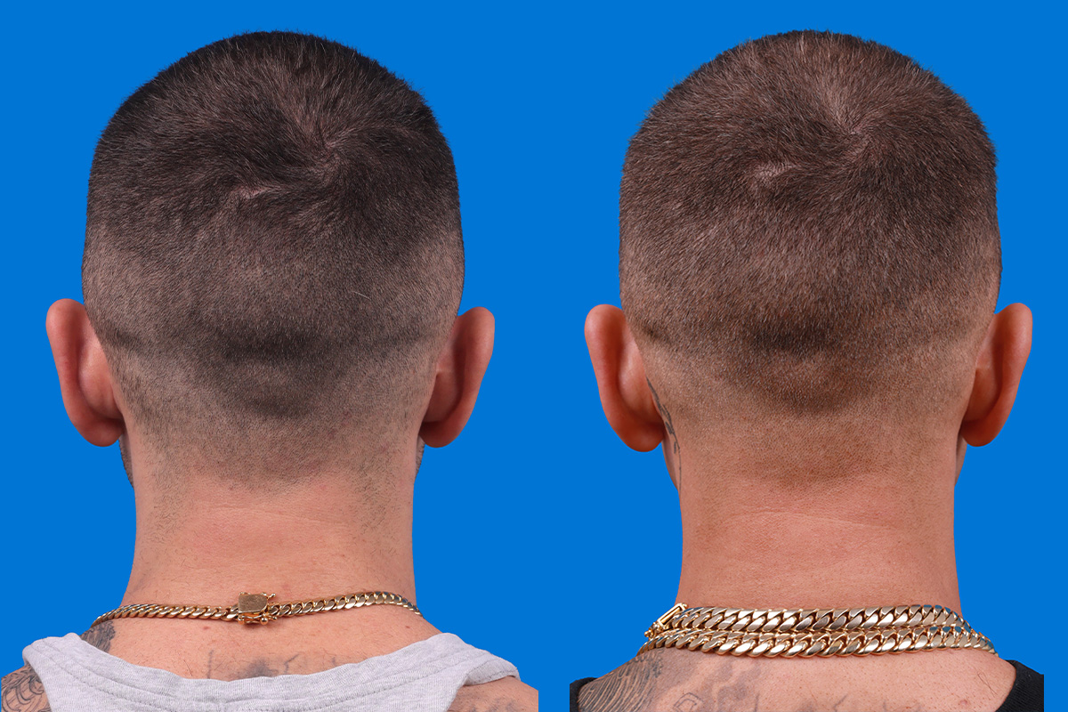 Hair Restoration Before & After Gallery - Patient 104786 - Image 6