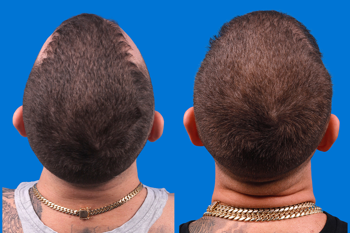 Hair Restoration Before & After Gallery - Patient 104786 - Image 8