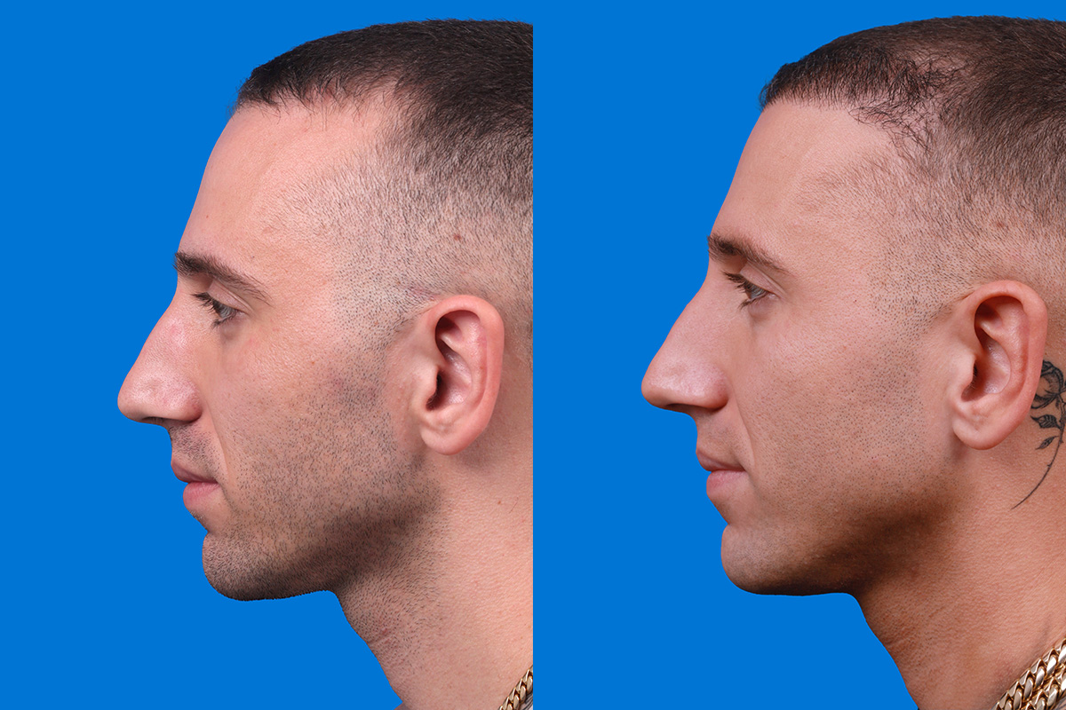 Hair Restoration Before & After Gallery - Patient 104786 - Image 5