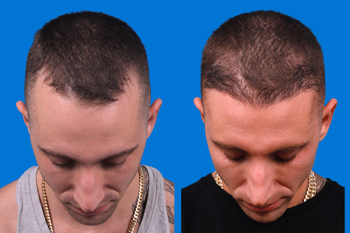 Hair Restoration Before & After Gallery - Patient 104786 - Image 7