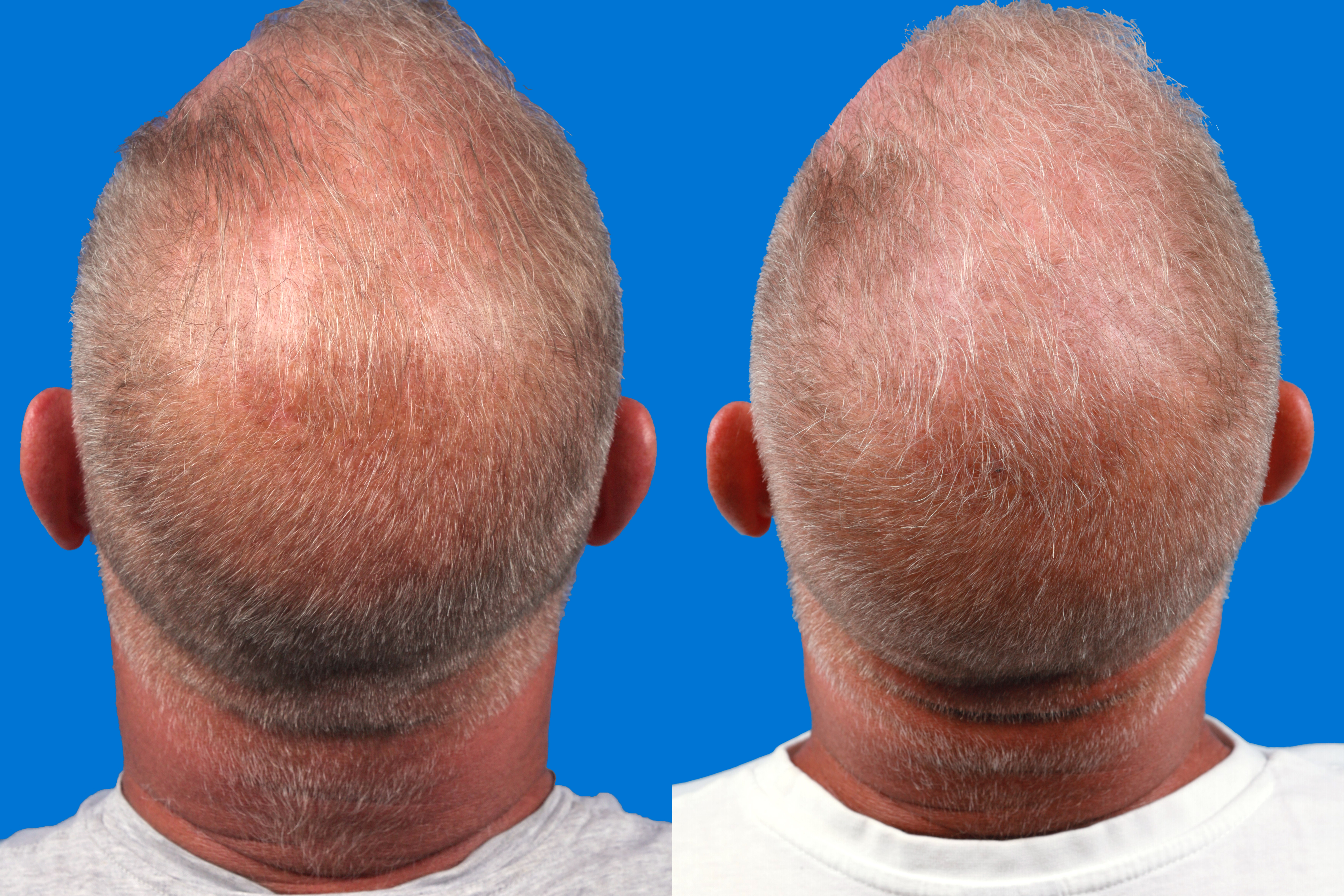 Hair Restoration Before & After Gallery - Patient 122593736 - Image 1
