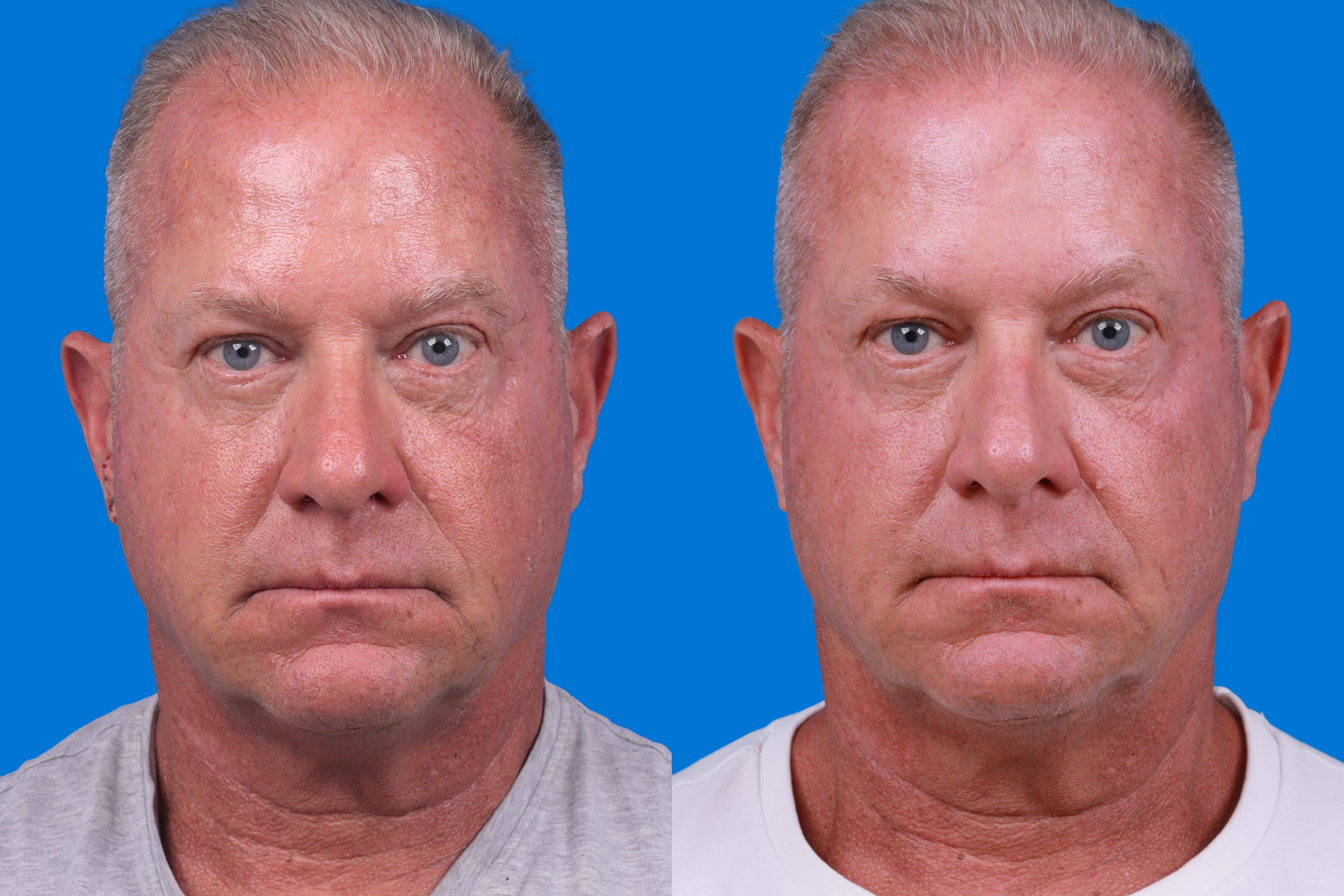 Hair Restoration Before & After Gallery - Patient 122593736 - Image 3