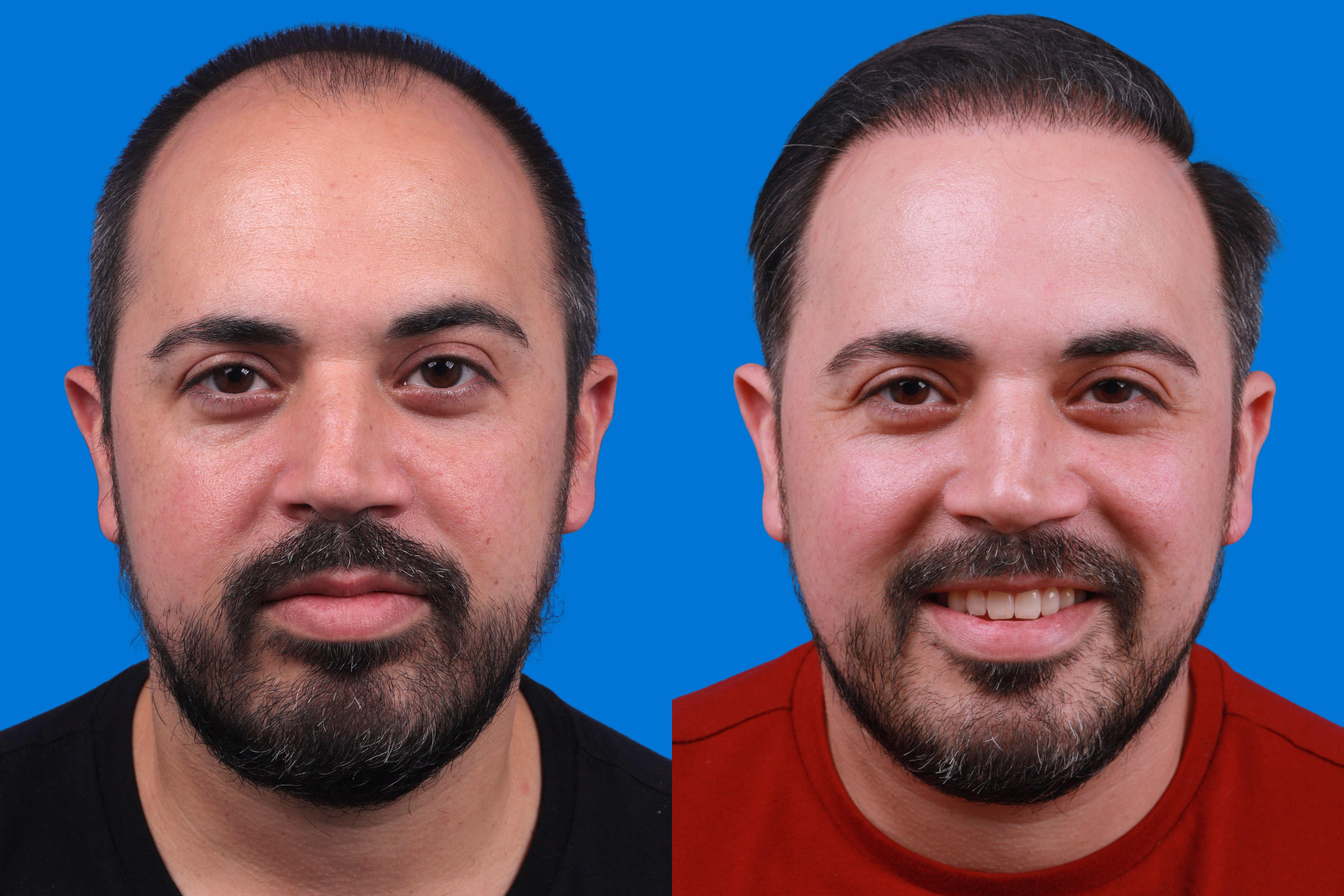 Hair Restoration Before & After Gallery - Patient 122593737 - Image 1