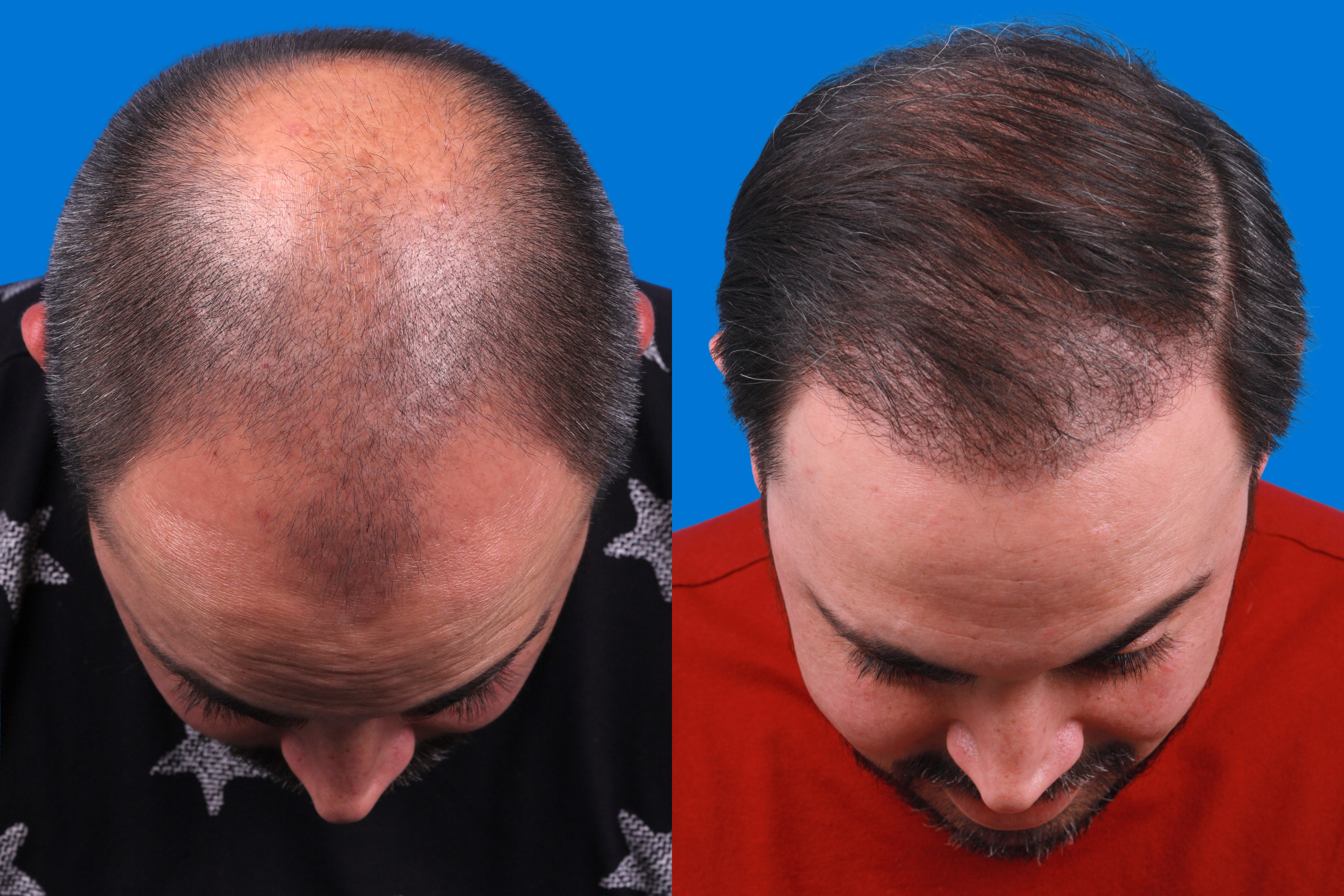 Hair Restoration Before & After Gallery - Patient 122593737 - Image 2