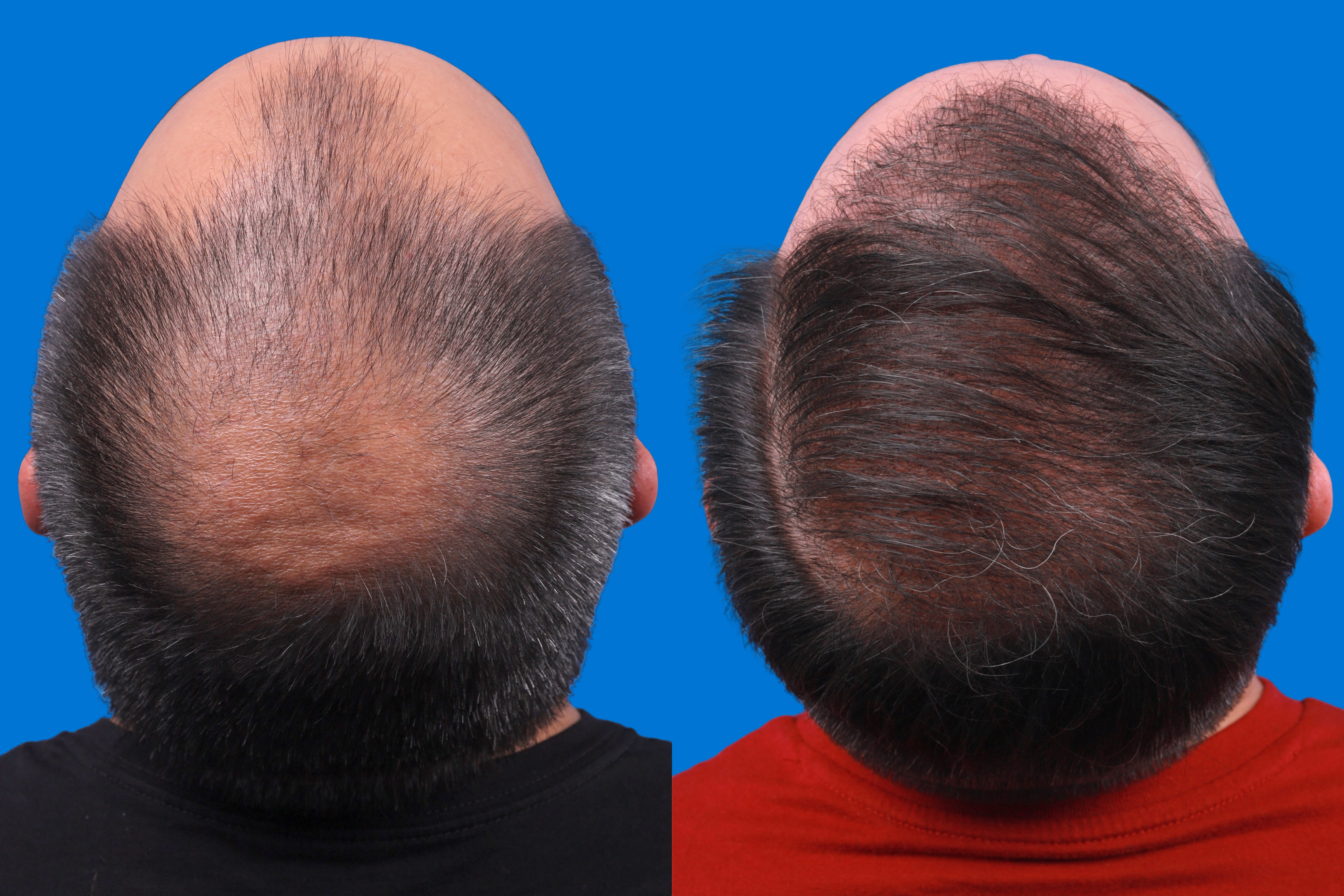 Hair Restoration Before & After Gallery - Patient 122593737 - Image 4