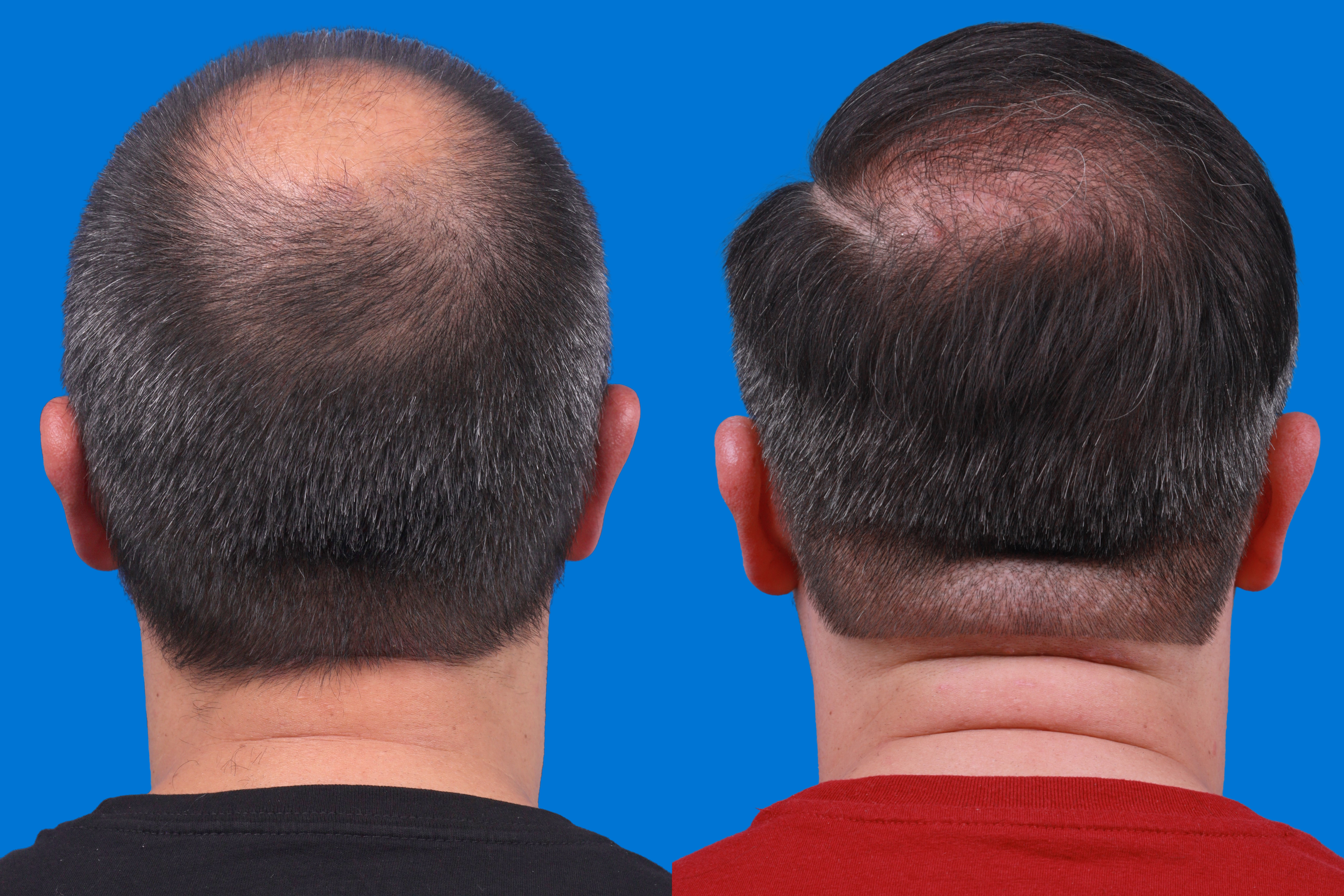 Hair Restoration Before & After Gallery - Patient 122593737 - Image 3