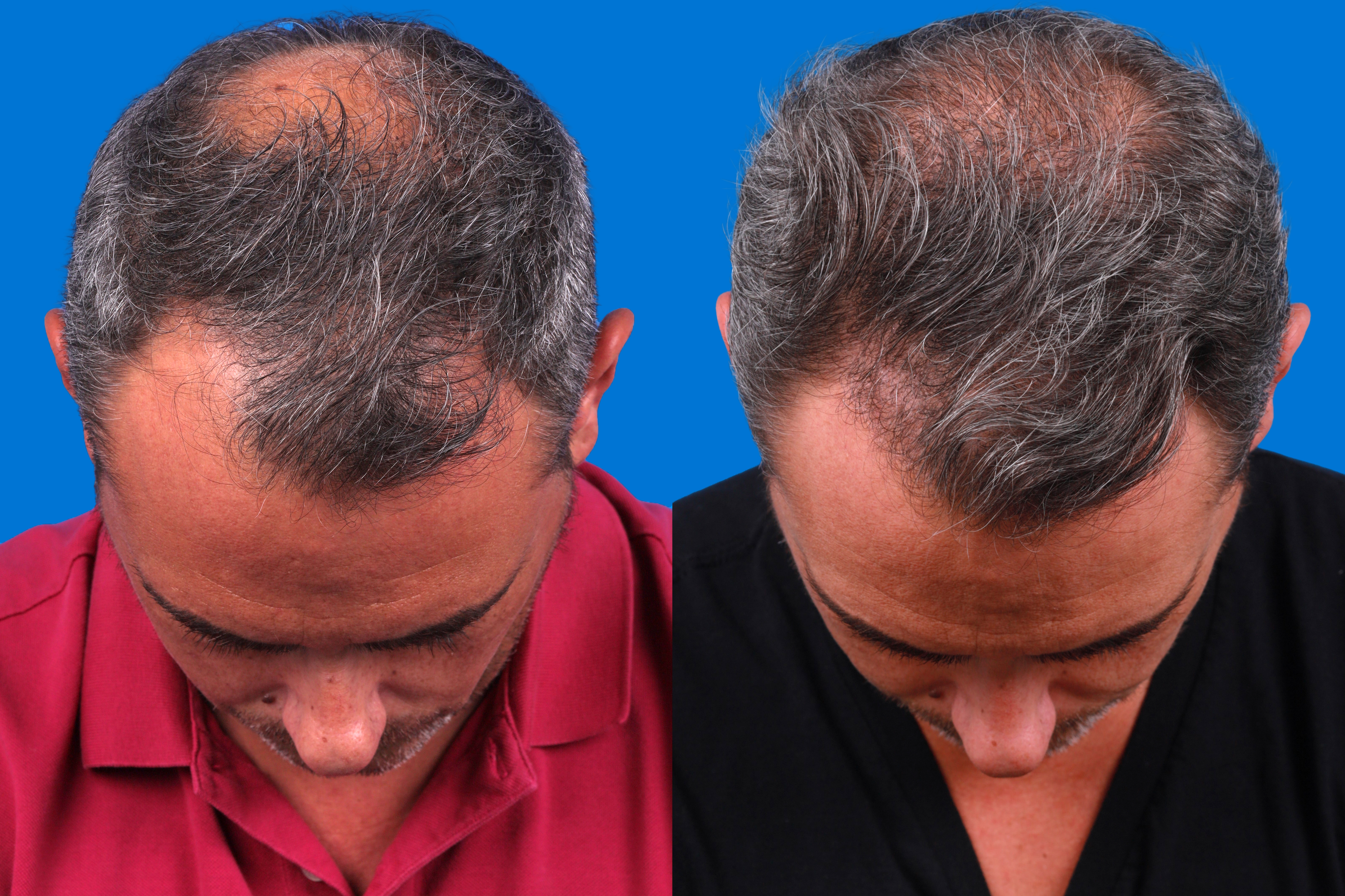 Hair Restoration Before & After Gallery - Patient 122593738 - Image 1