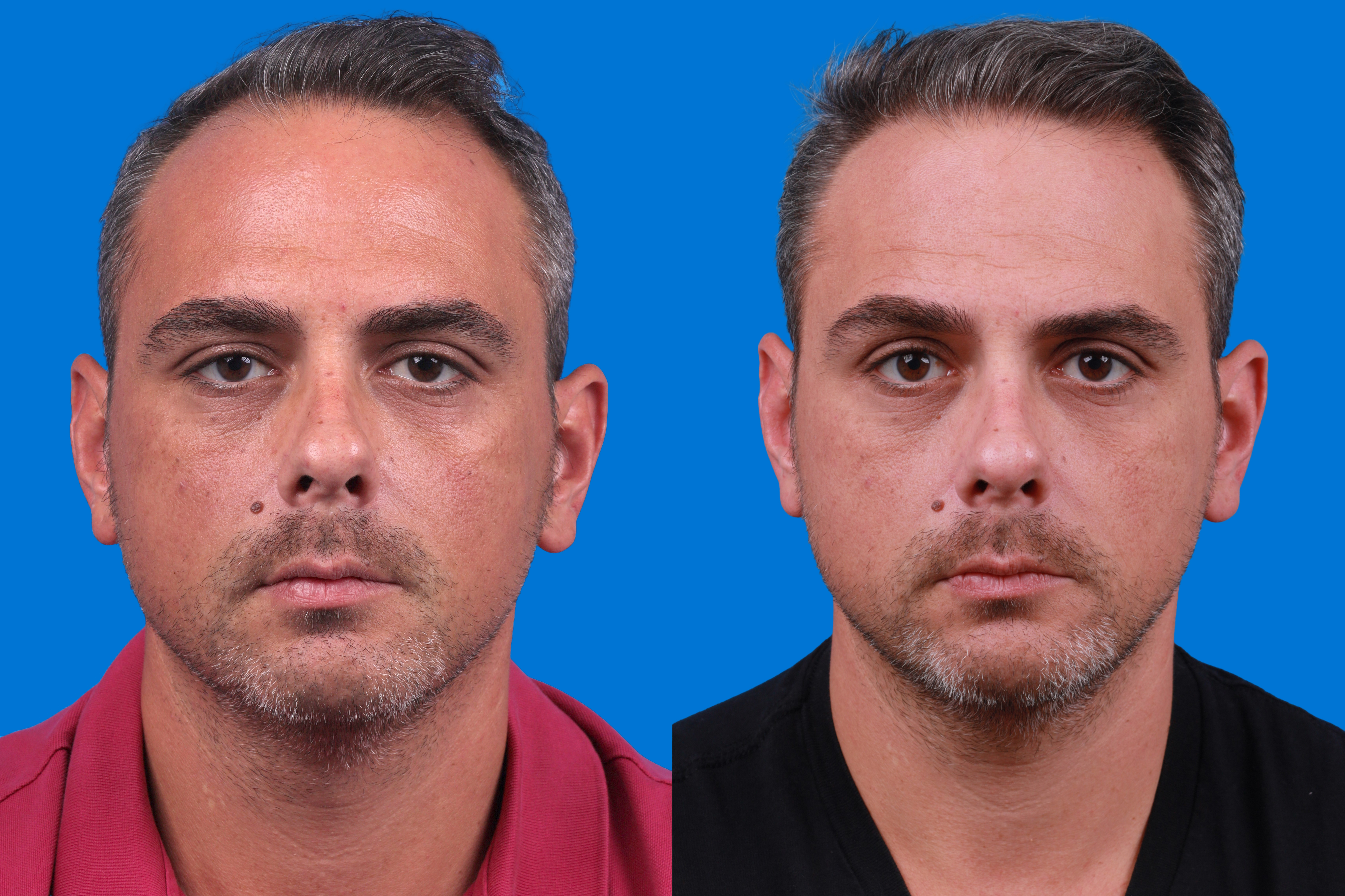 Hair Restoration Before & After Gallery - Patient 122593738 - Image 2