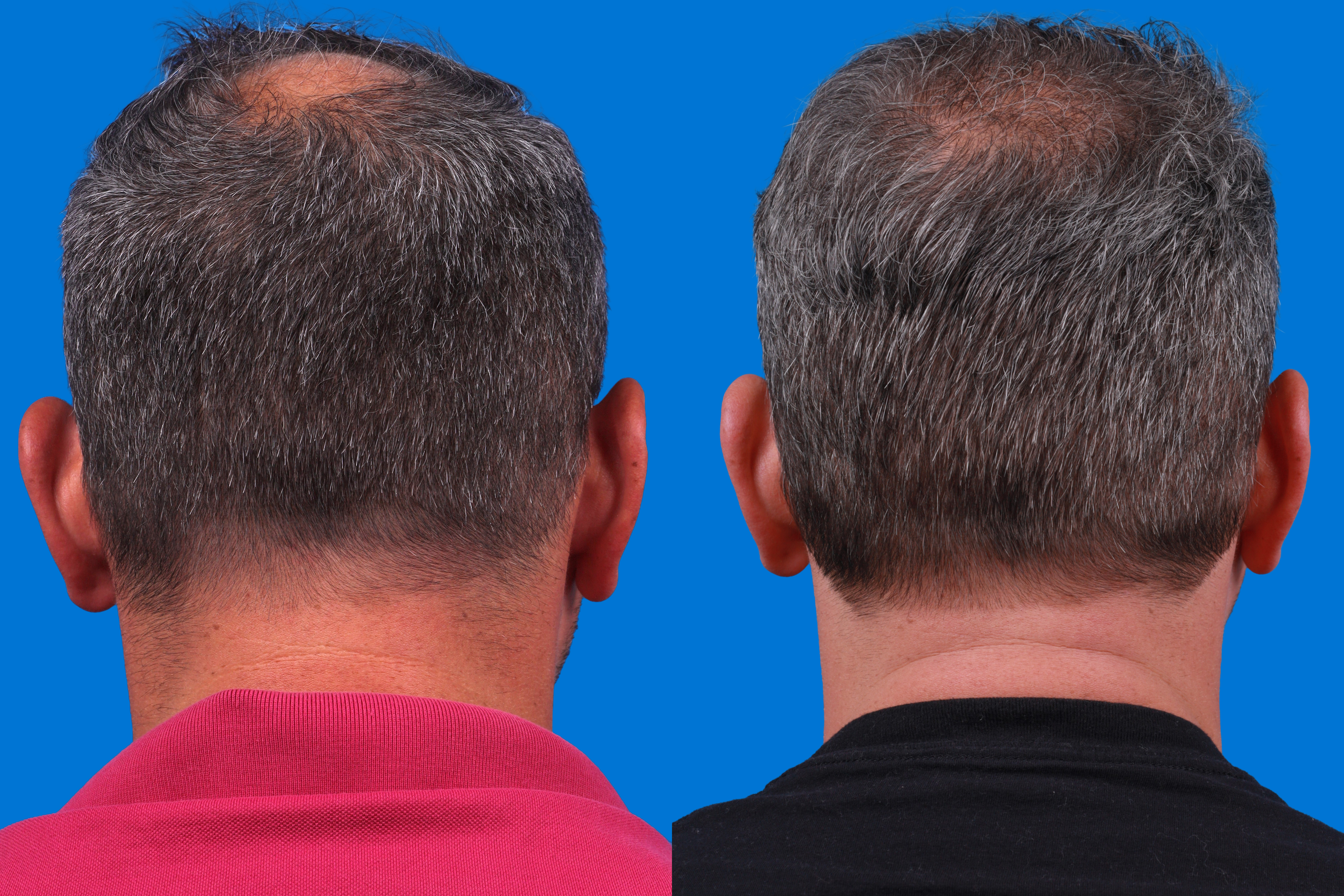Hair Restoration Before & After Gallery - Patient 122593738 - Image 3