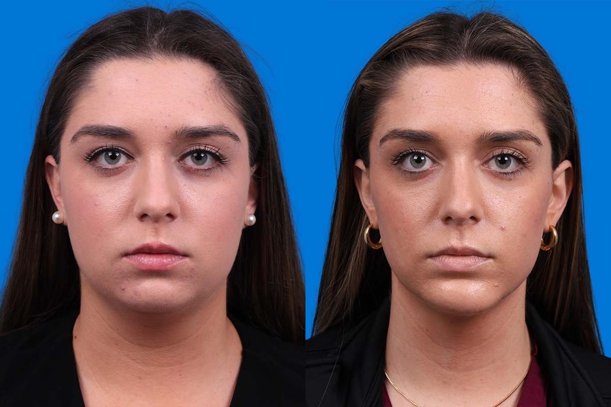 Chin Augmentation Before & After Gallery - Patient 122591906 - Image 3