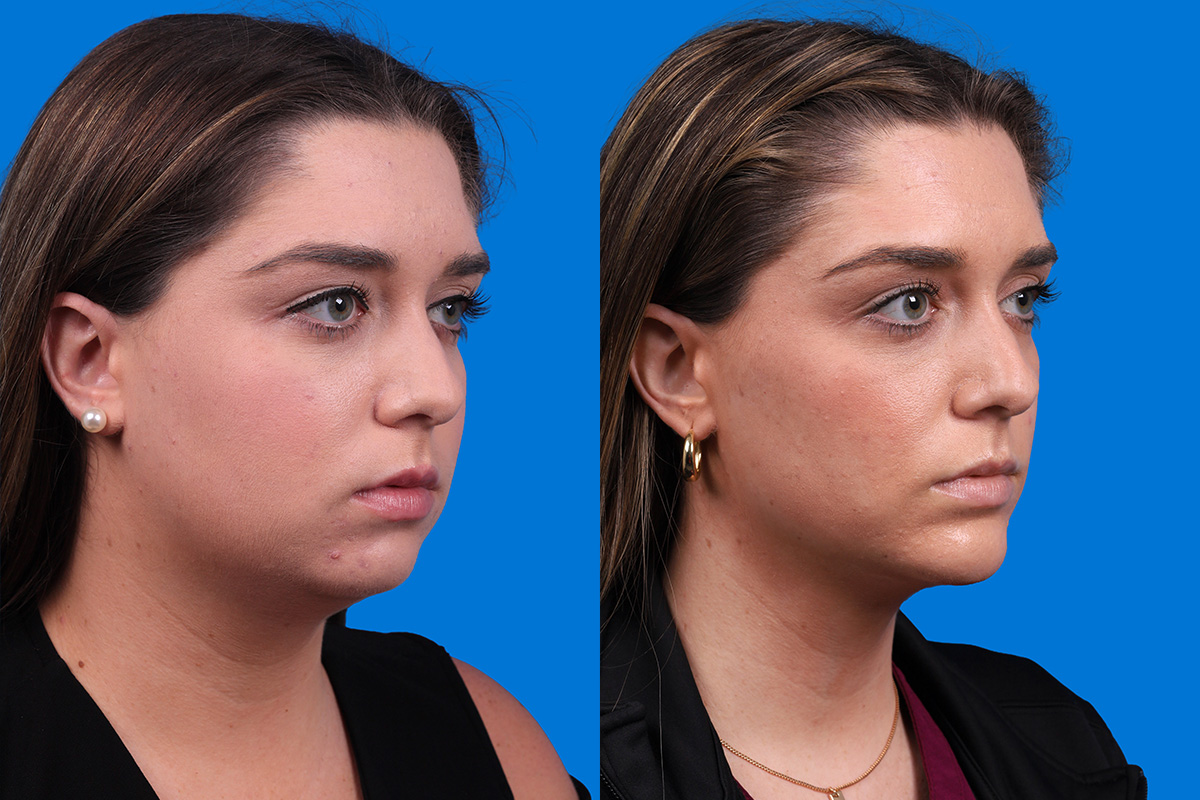 Chin Augmentation Before & After Gallery - Patient 122591906 - Image 2