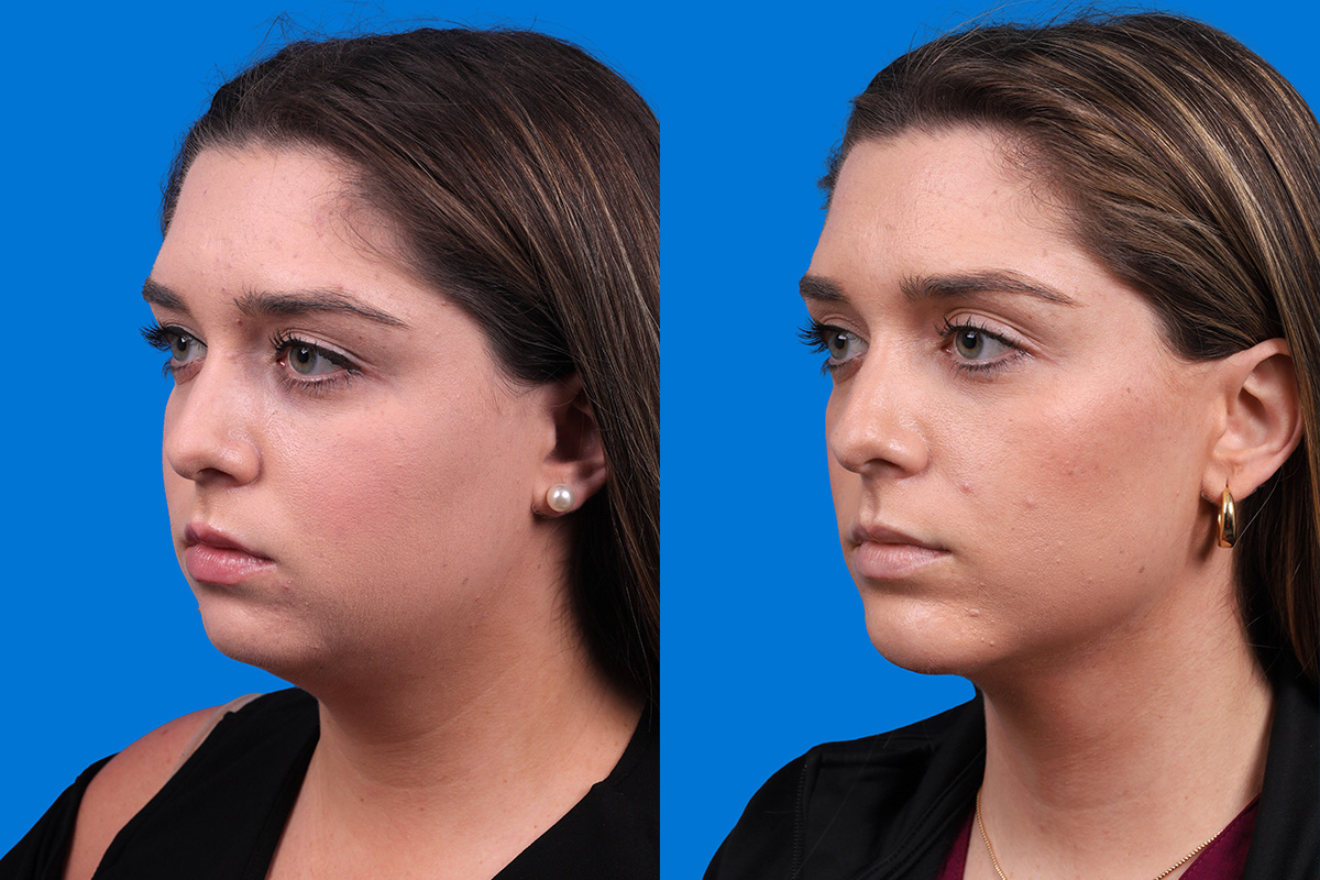 Chin Augmentation Before & After Gallery - Patient 122591906 - Image 4