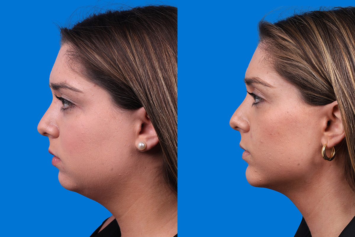 Chin Augmentation Before & After Gallery - Patient 122591906 - Image 5