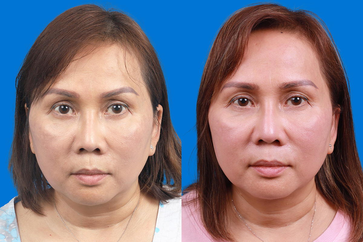 Rhinoplasty Before & After Gallery - Patient 227546 - Image 1