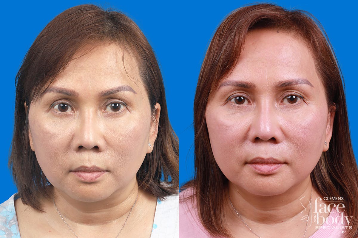 Rhinoplasty Before & After Gallery - Patient 227546 - Image 1
